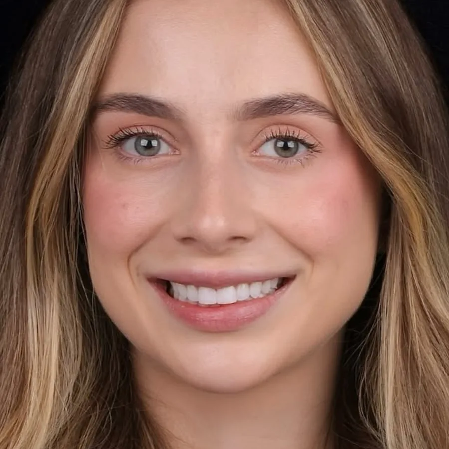Before: veneer and zirconia smile restoration, 3010