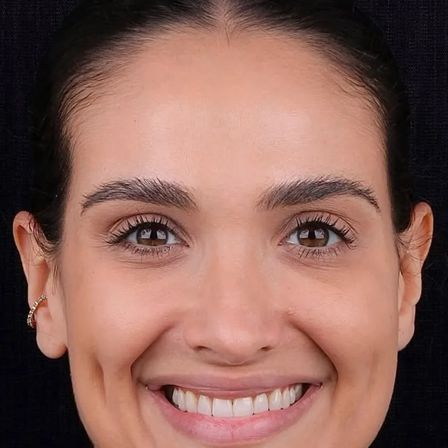 Before: veneer and zirconia smile restoration, 3012