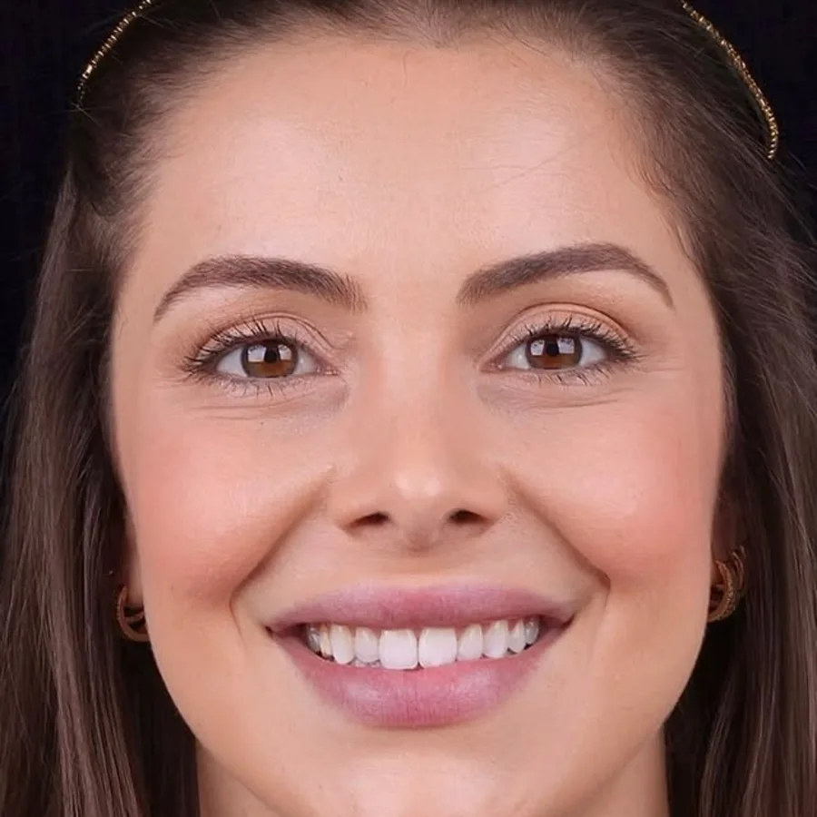 Before: veneer and zirconia smile restoration, 3013