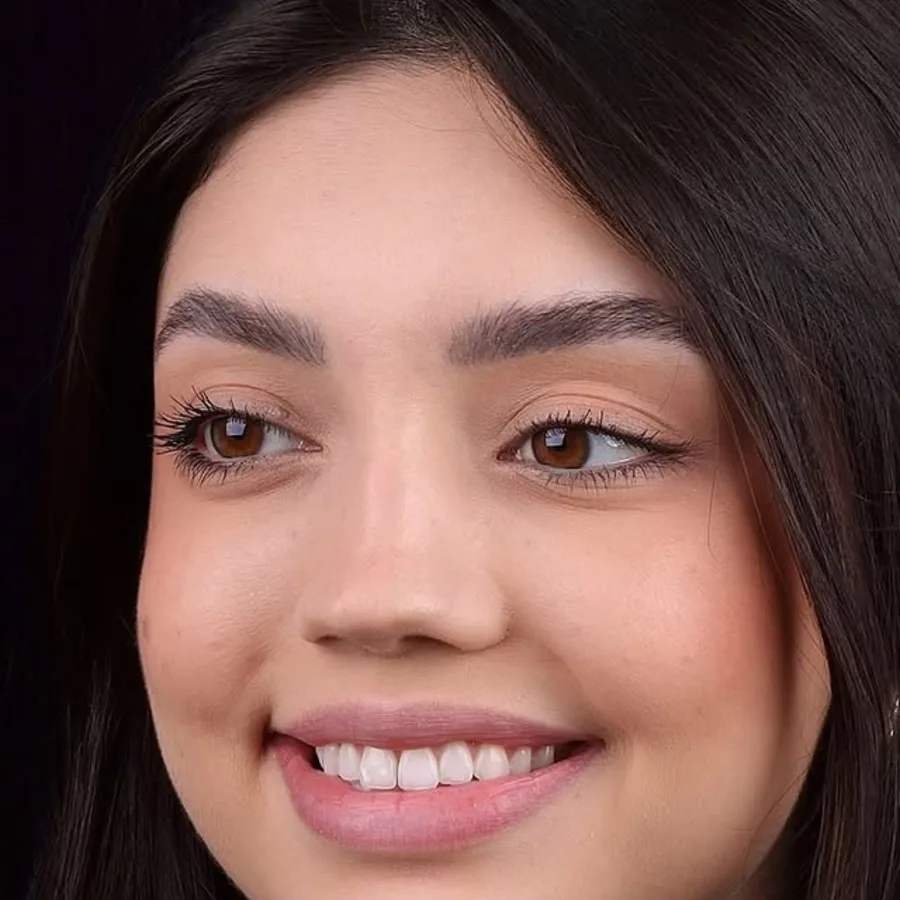 Before: veneer and zirconia smile restoration, 3014