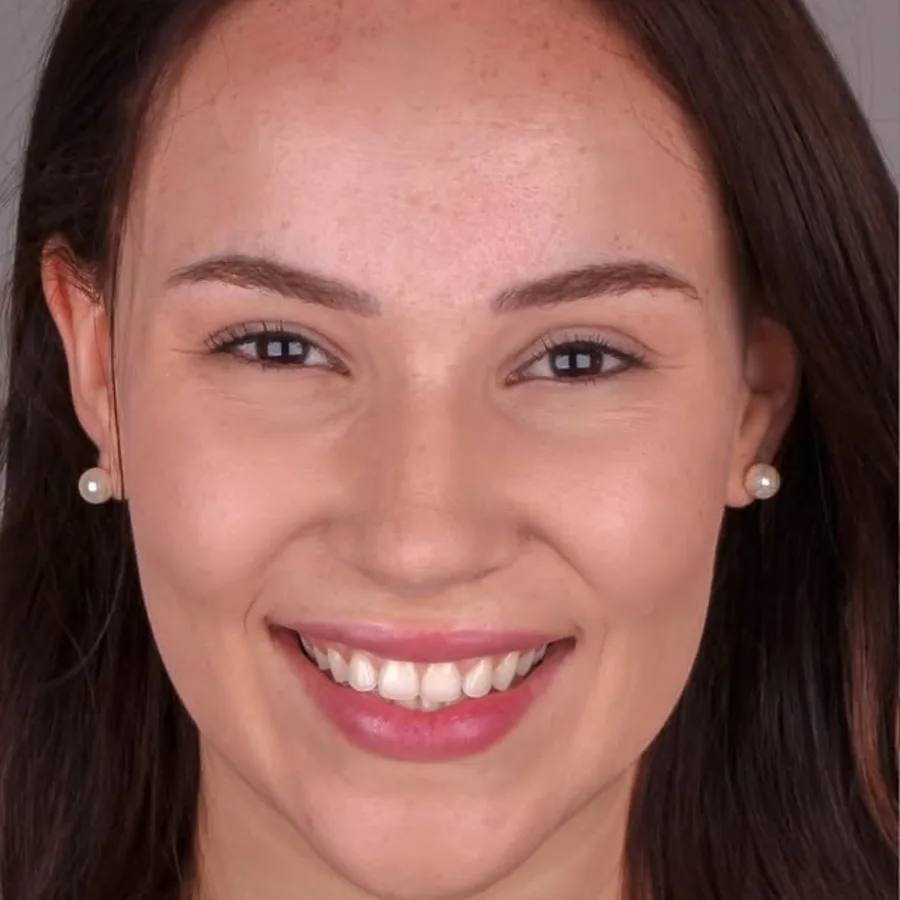 Before: veneer and zirconia smile restoration, 3018