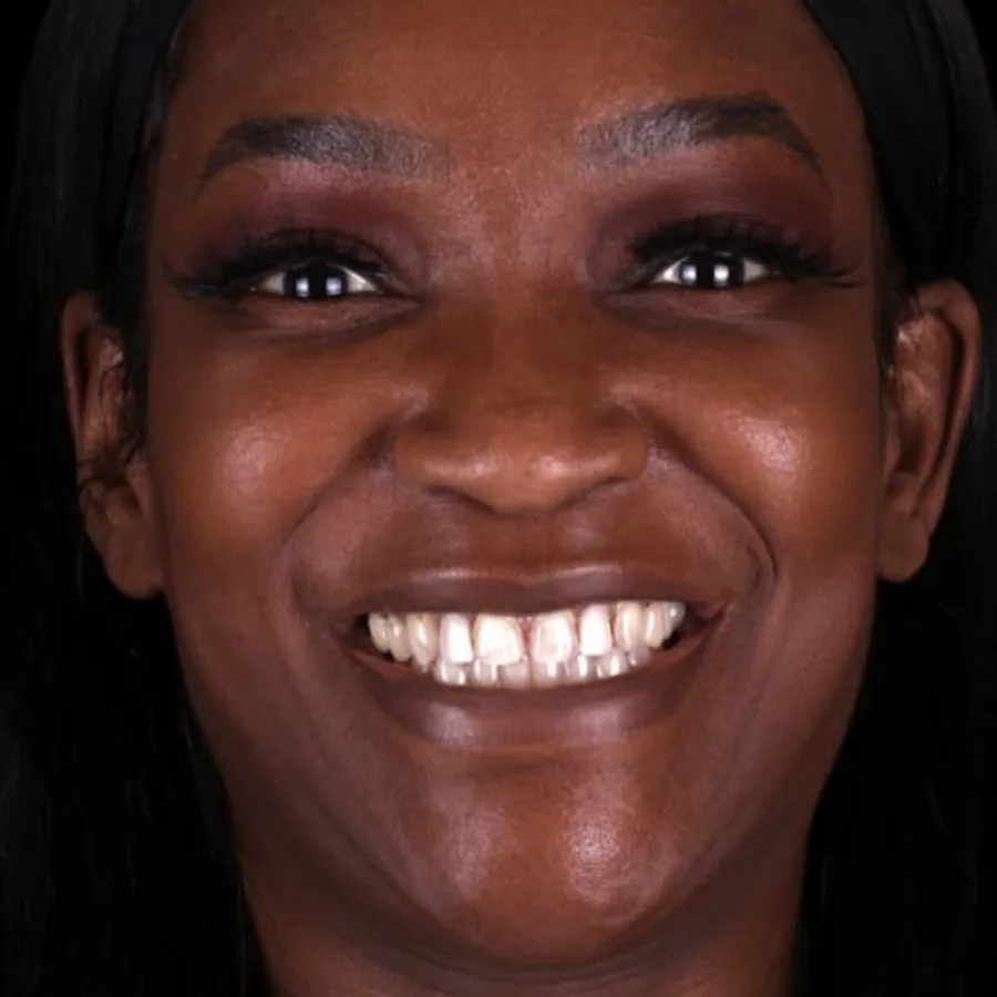 Before: veneer and zirconia smile restoration, 3019