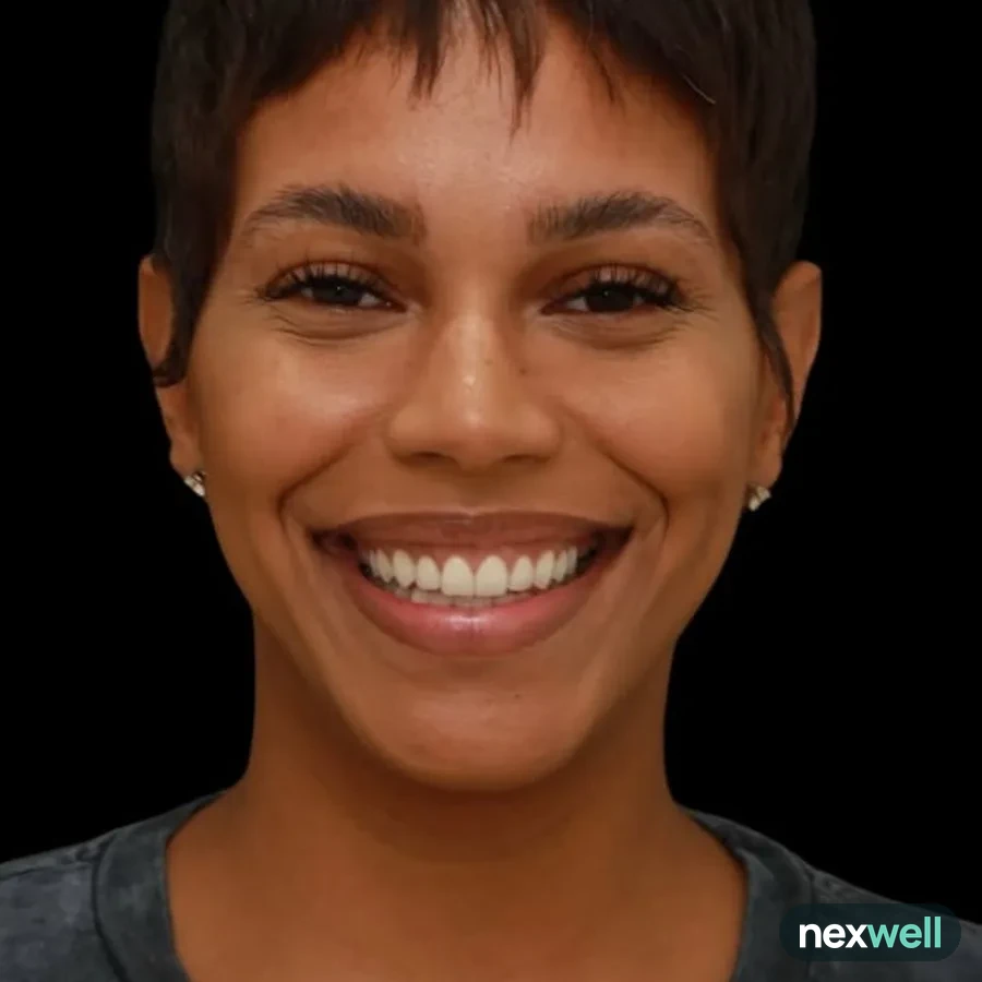 After: veneer and zirconia smile restoration, 3020