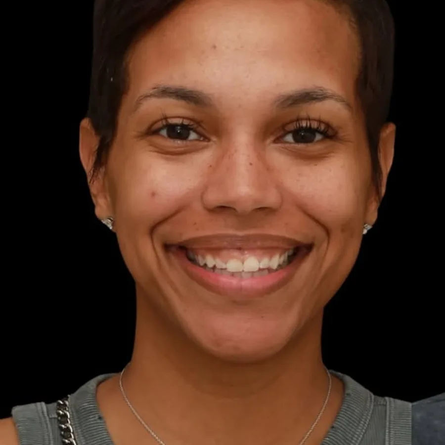 Before: veneer and zirconia smile restoration, 3020