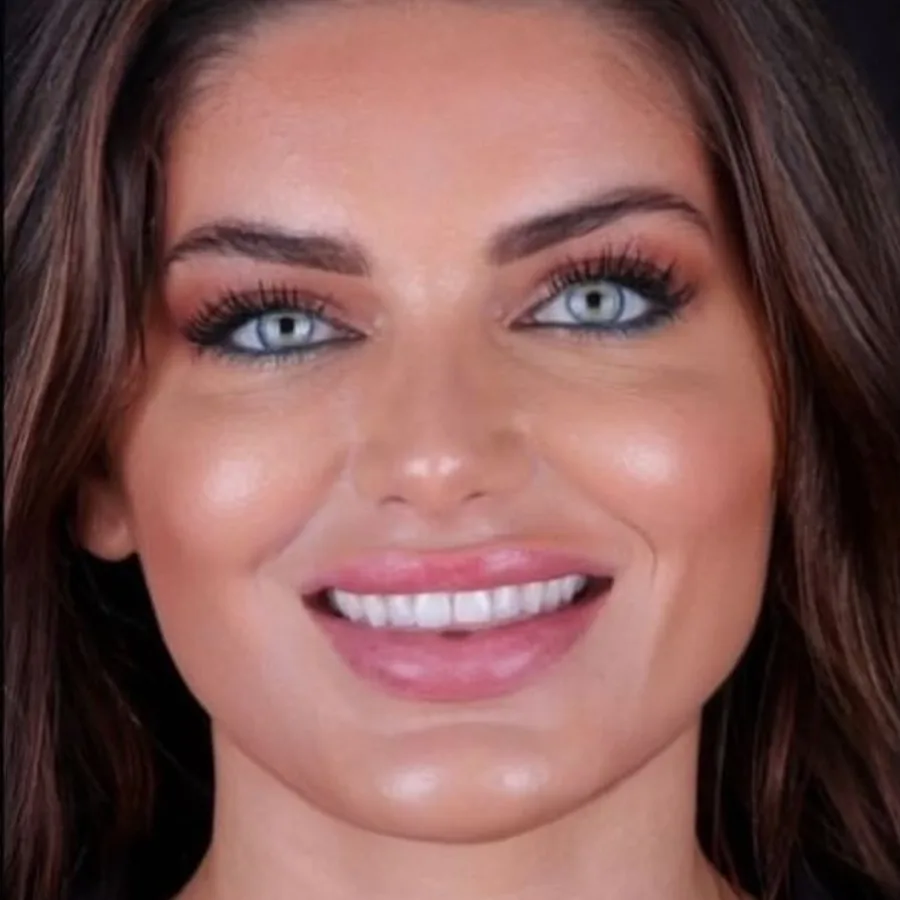 Before: veneer and zirconia smile restoration, 3021