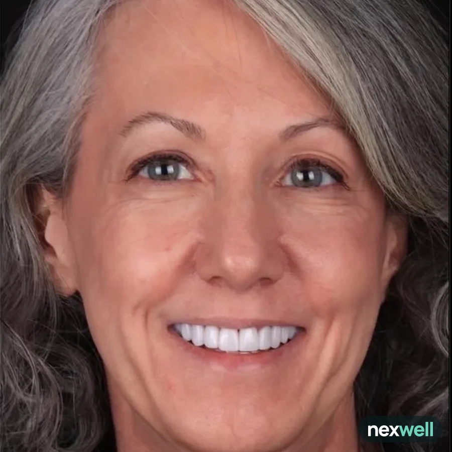 After: veneer and zirconia smile restoration, 3022