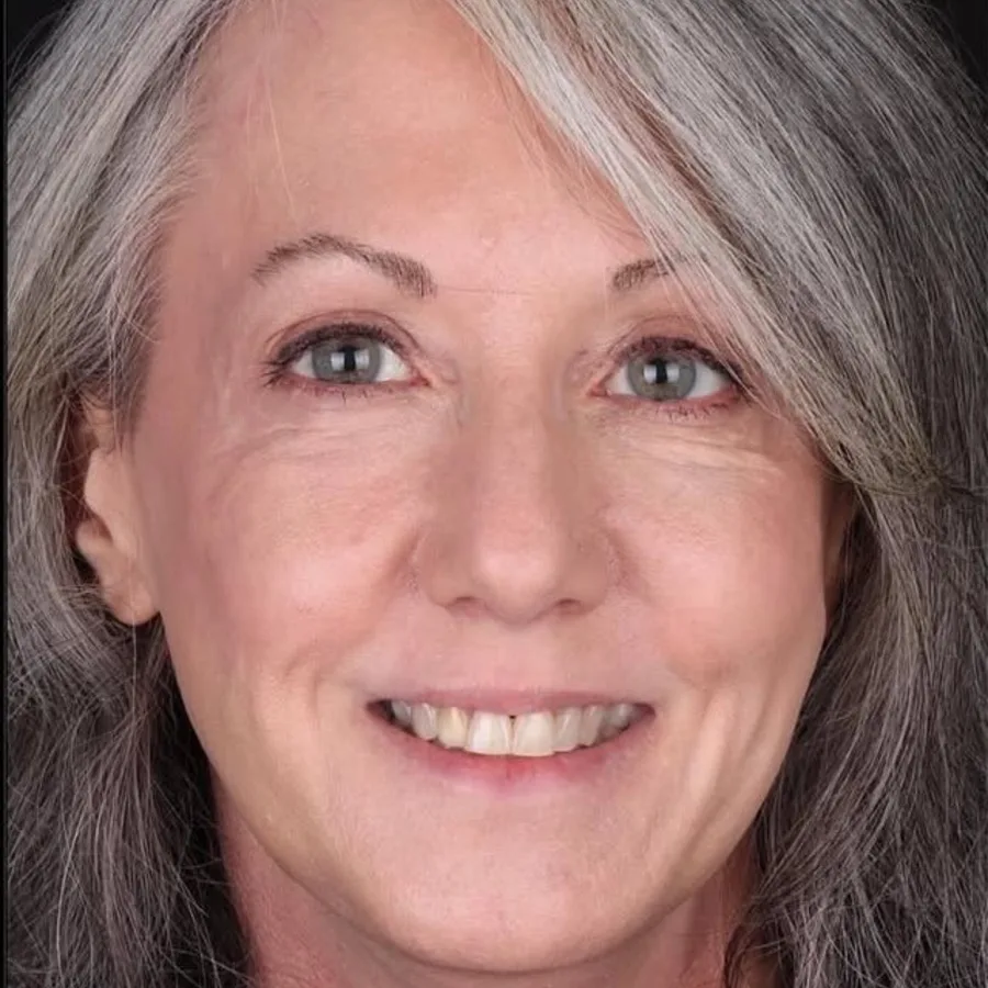 Before: veneer and zirconia smile restoration, 3022