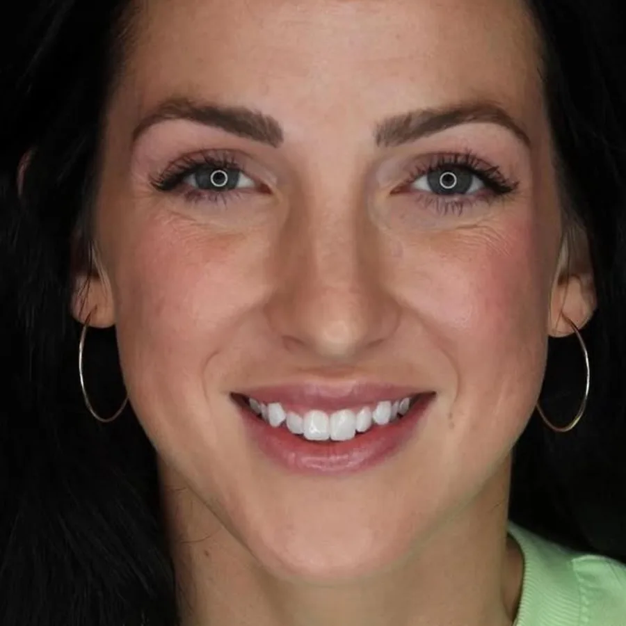 Before: veneer and zirconia smile restoration, 3023