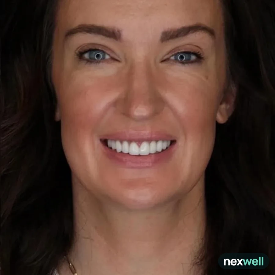 After: veneer and zirconia smile restoration, 3024
