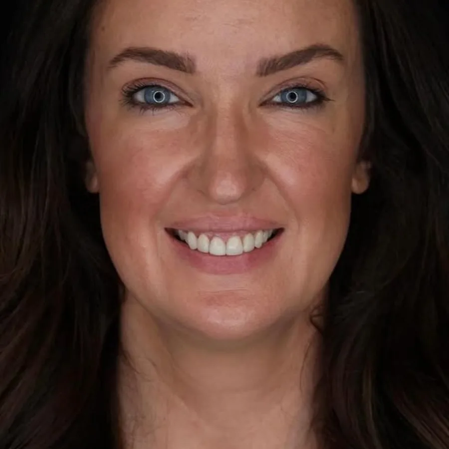 Before: veneer and zirconia smile restoration, 3024