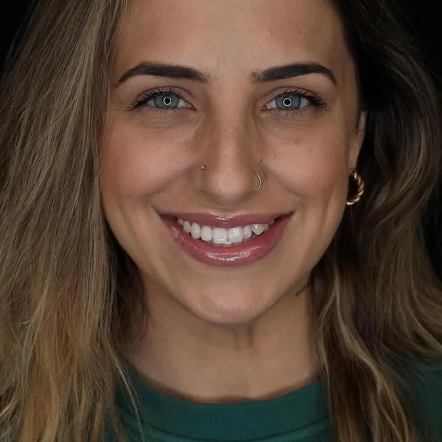 Before: veneer and zirconia smile restoration, 3025