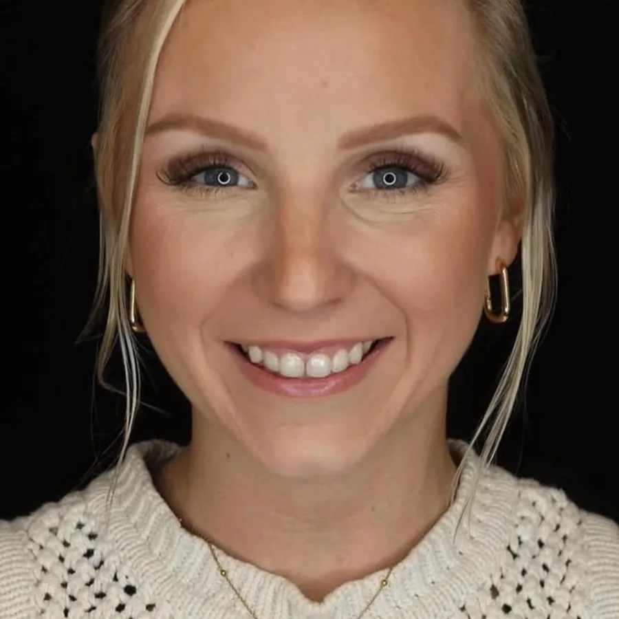 Before: veneer and zirconia smile restoration, 3026