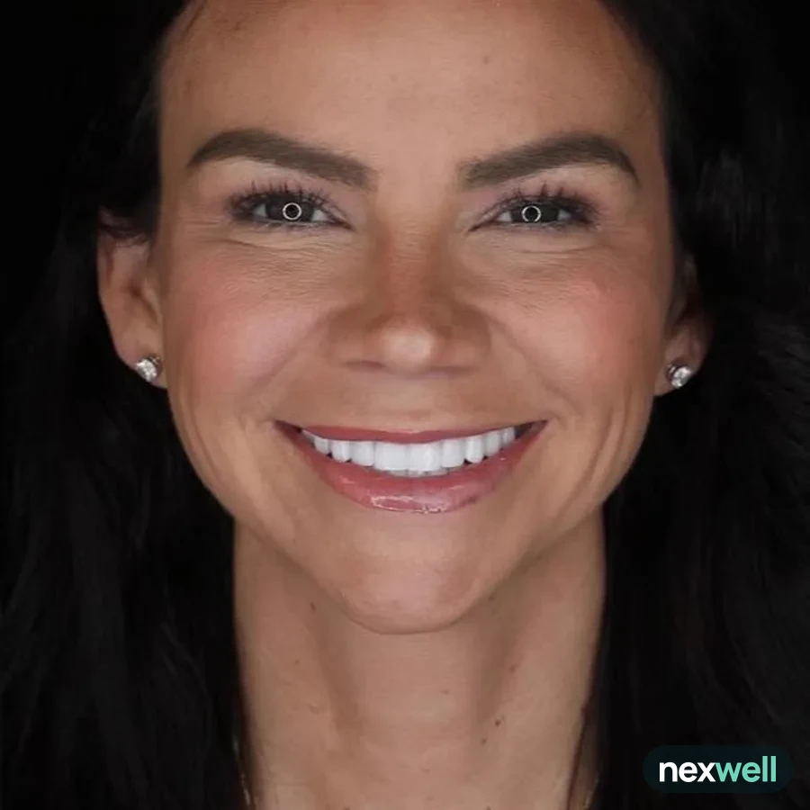 After: veneer and zirconia smile restoration, 3027