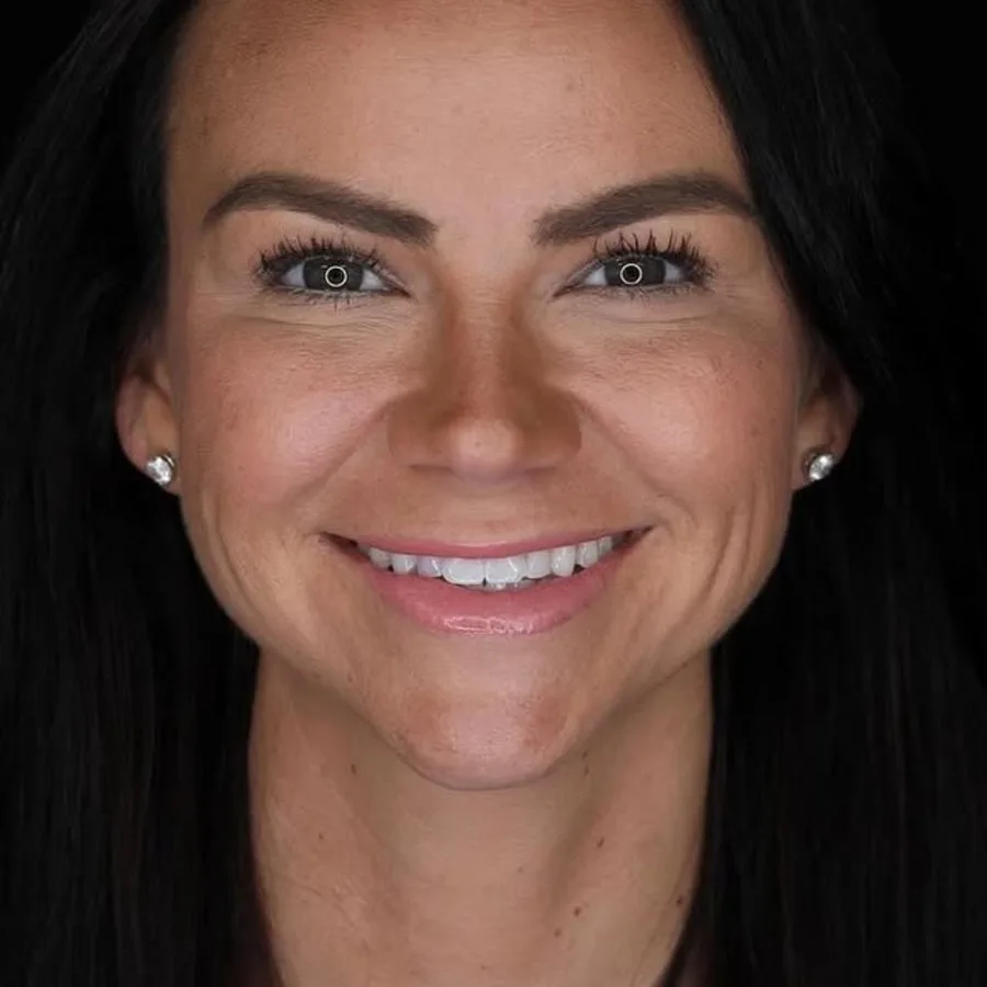 Before: veneer and zirconia smile restoration, 3027