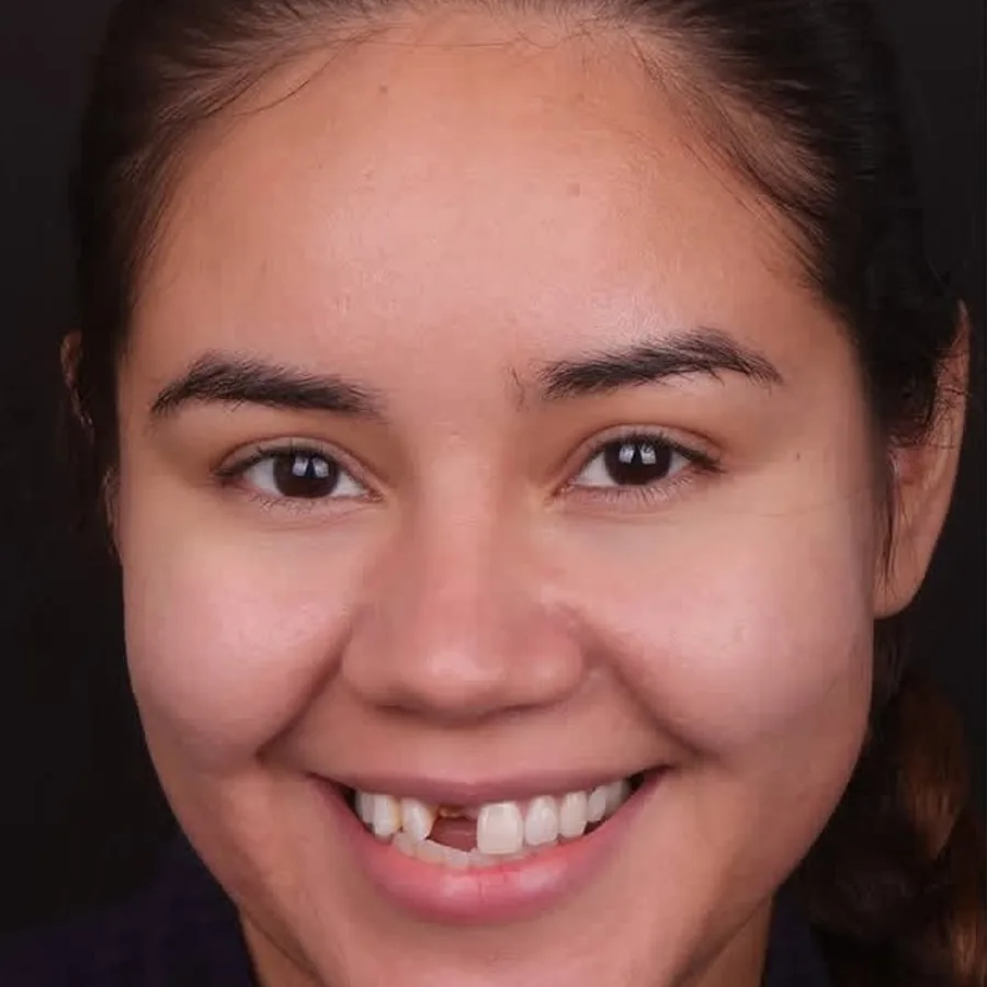 Before: veneer and zirconia smile restoration, 3028