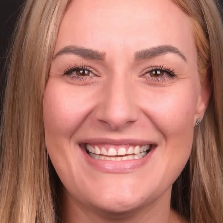 Before: veneer and zirconia smile restoration, 3029