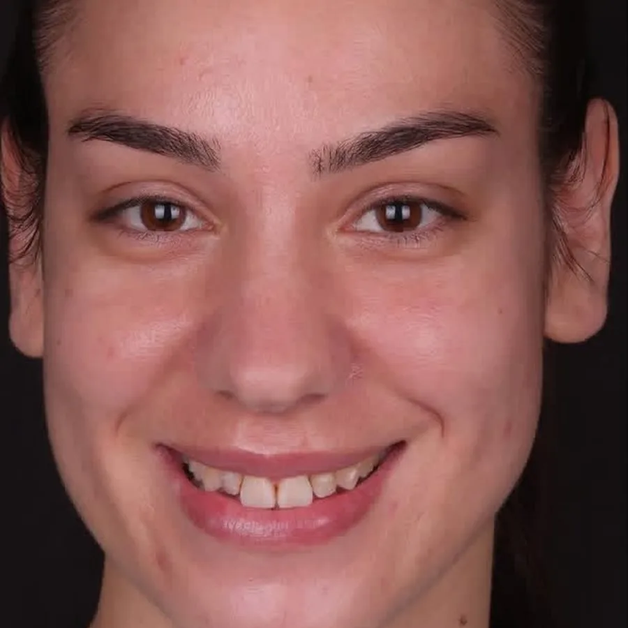 Before: veneer and zirconia smile restoration, 3030