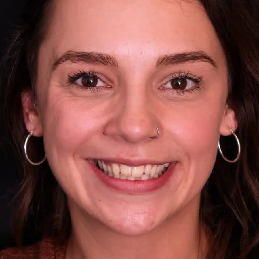 Before: veneer and zirconia smile restoration, 3032