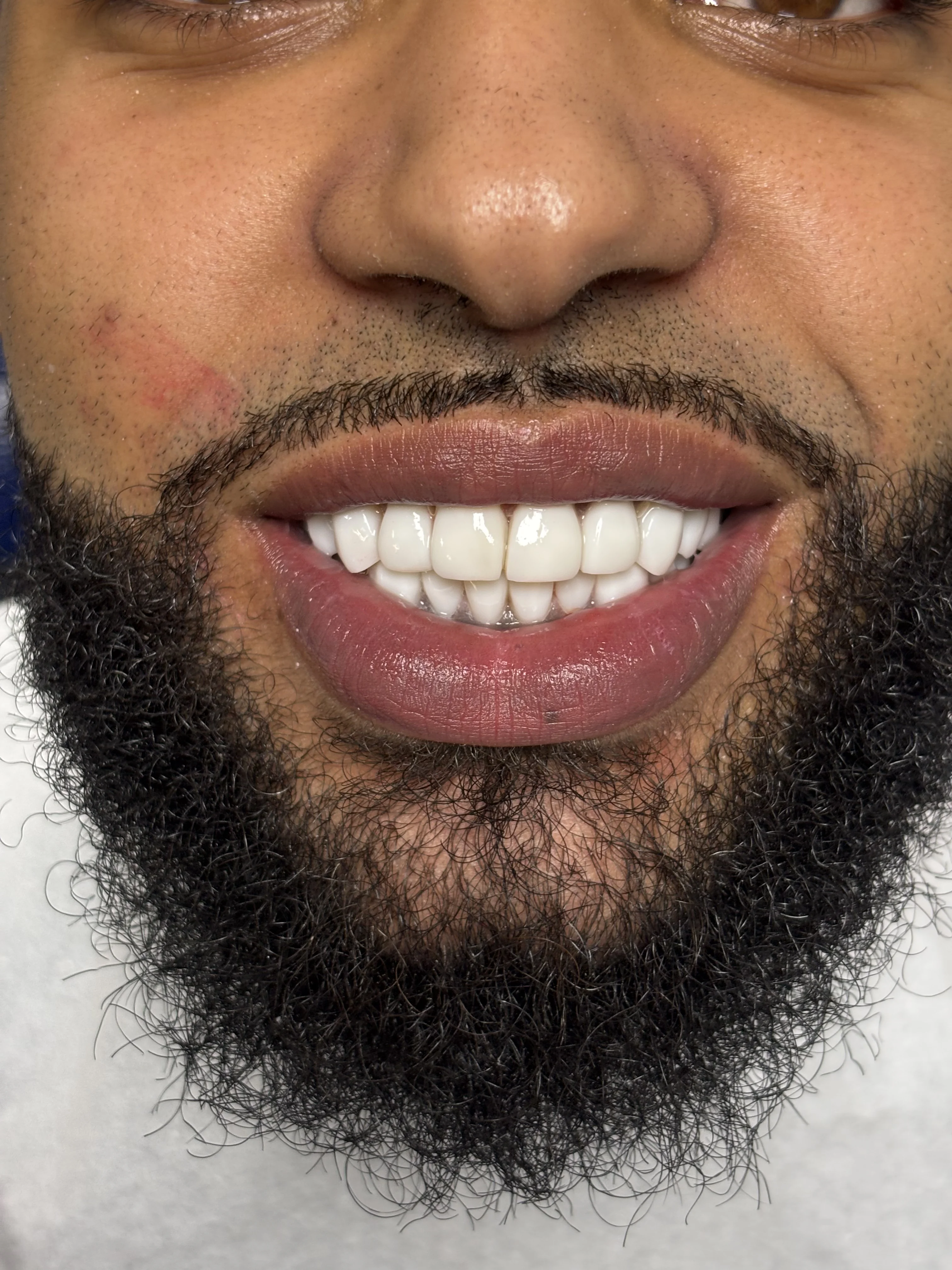 Composite bonding after case 1 — Istanbul NexWell