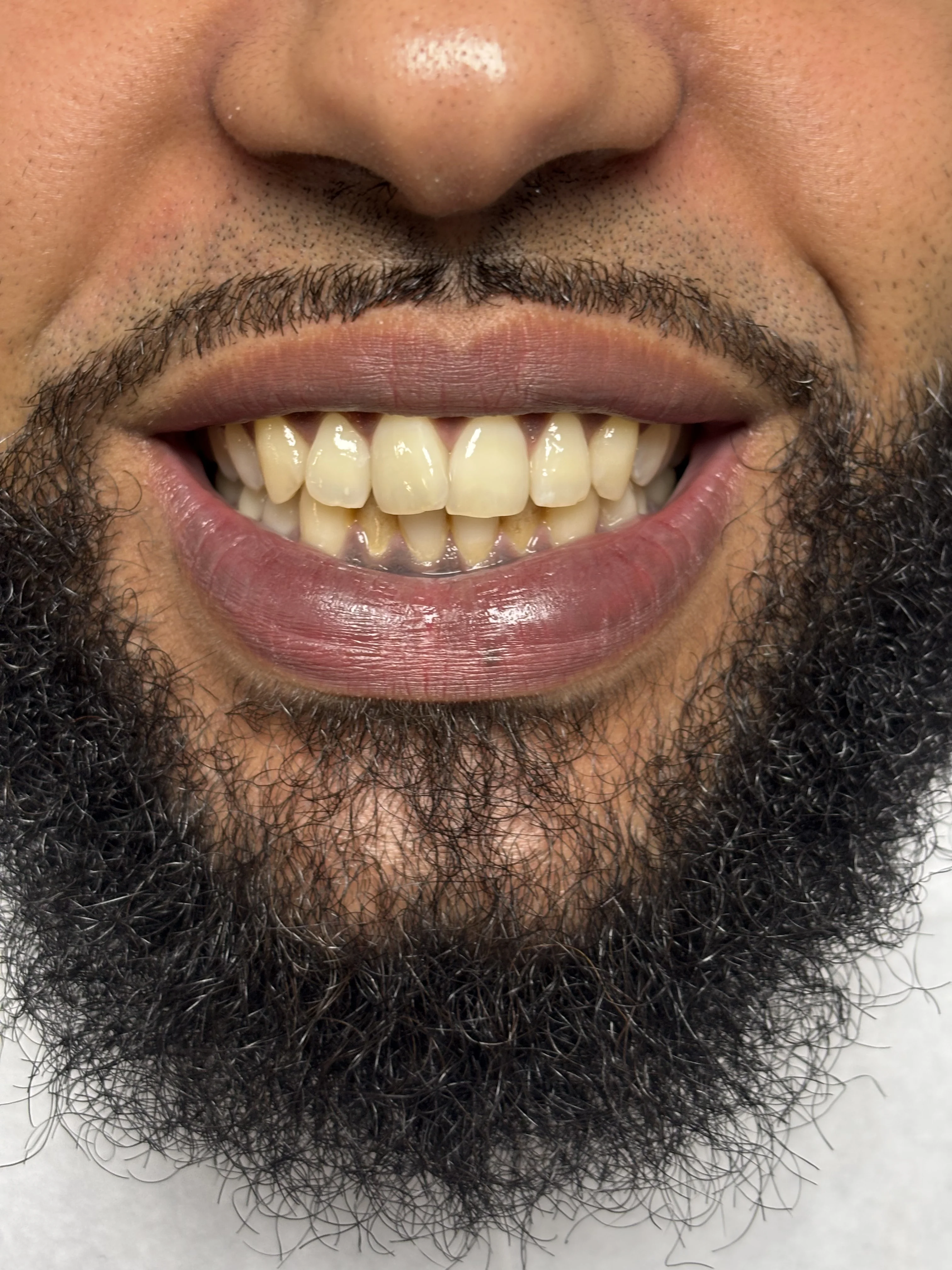Composite bonding before case 1 — Istanbul