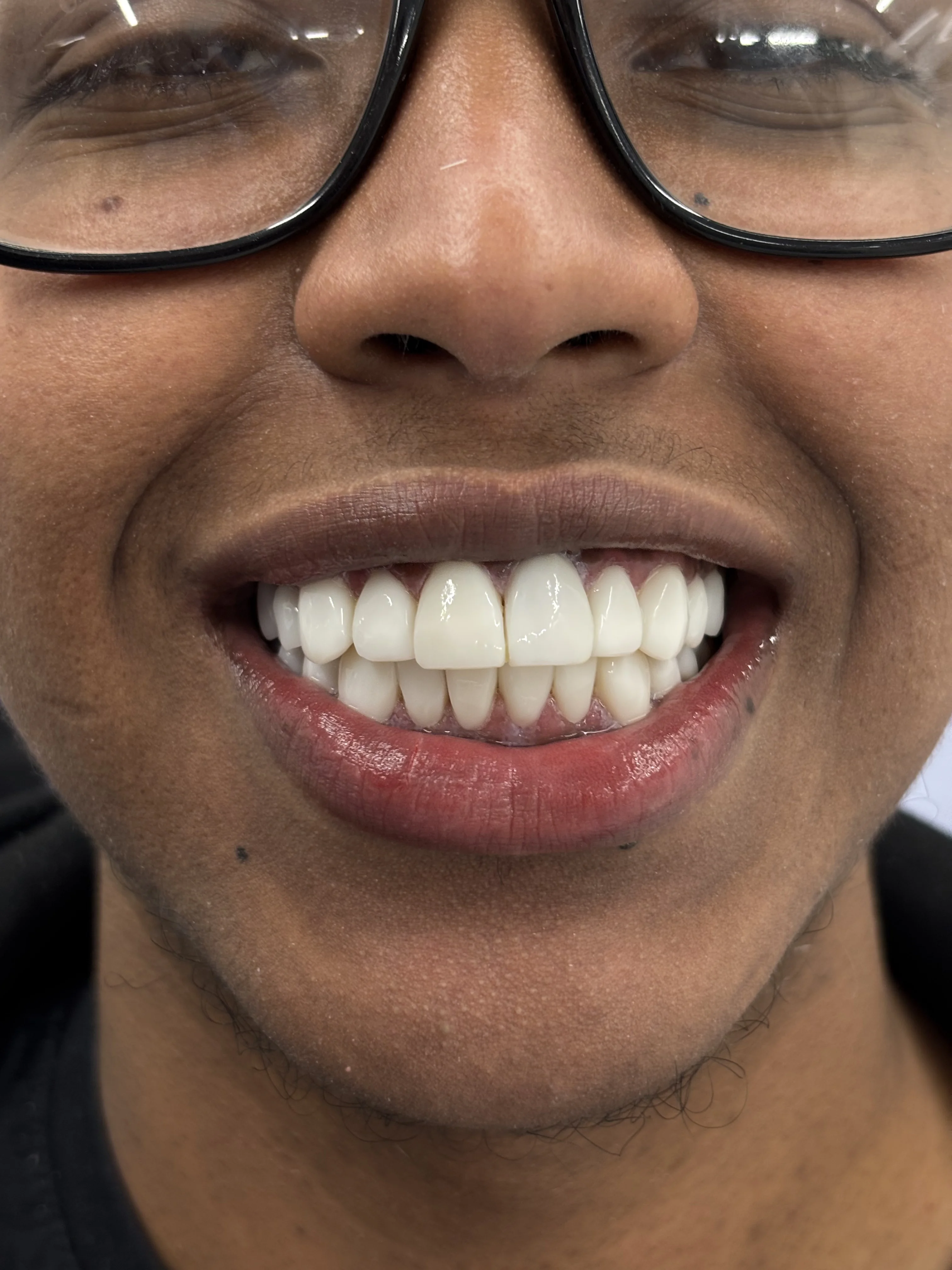 Composite bonding after case 2 — Istanbul NexWell