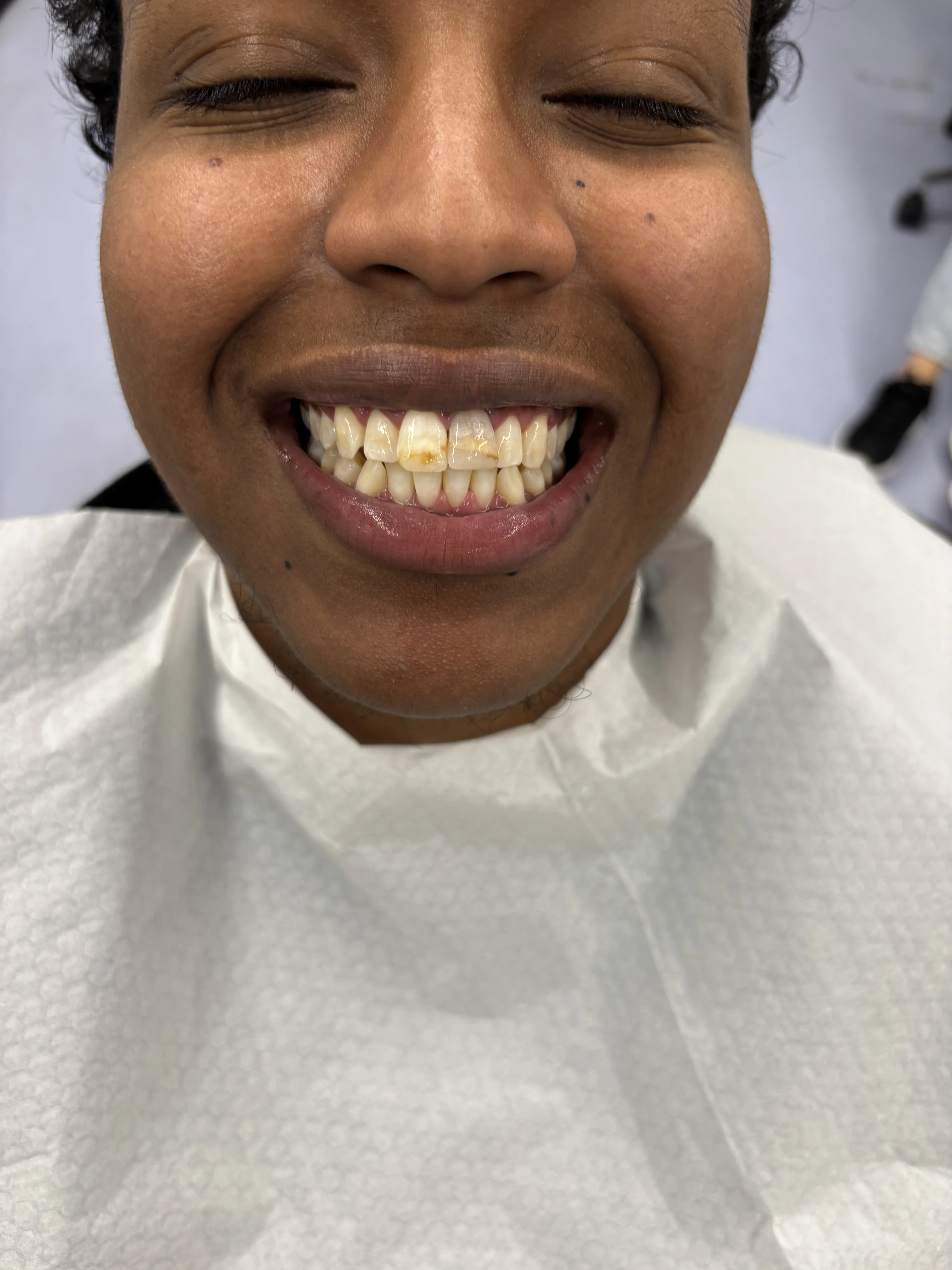 Composite bonding before case 2 — Istanbul