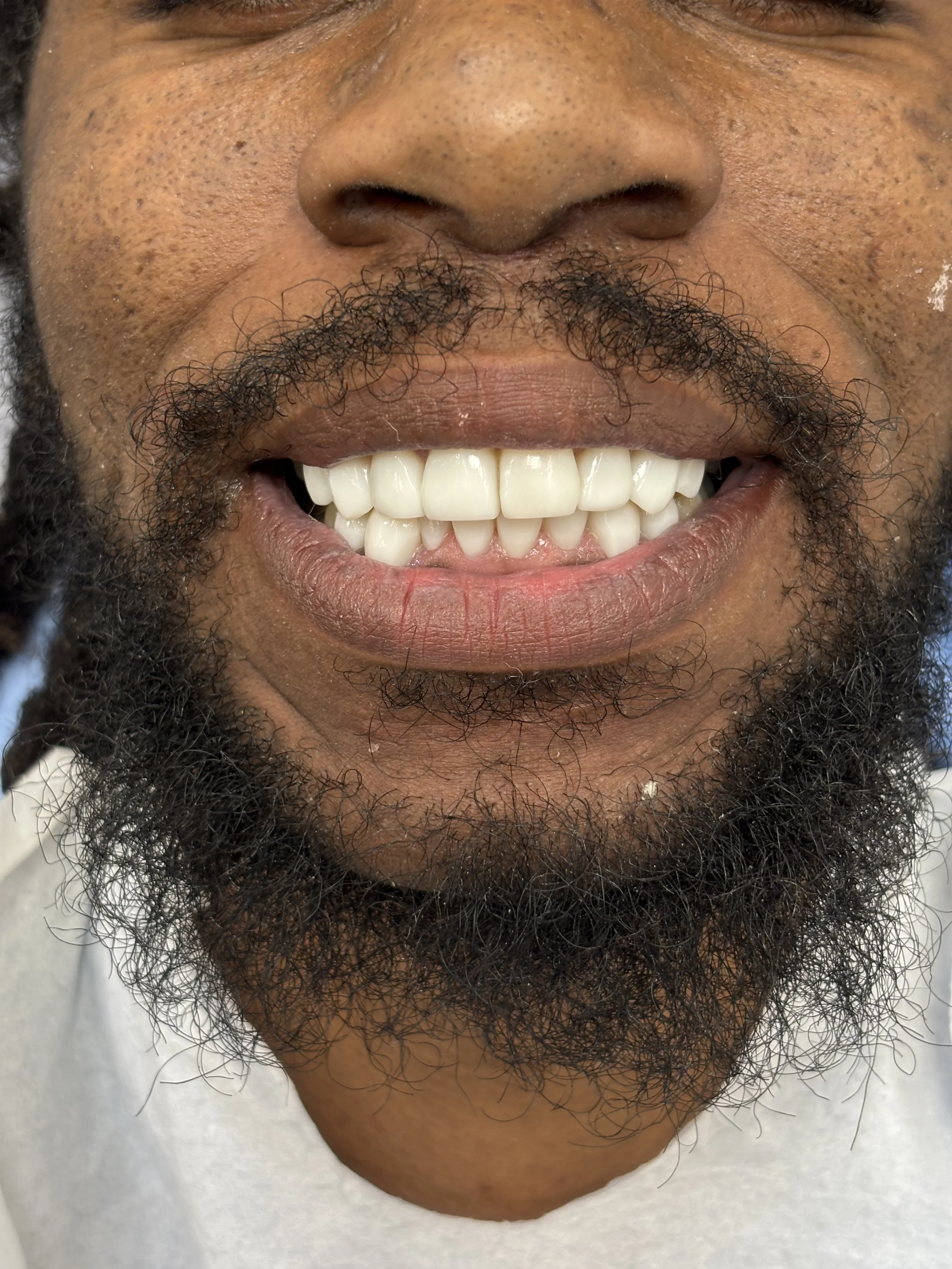 Composite bonding after case 3 — Istanbul NexWell