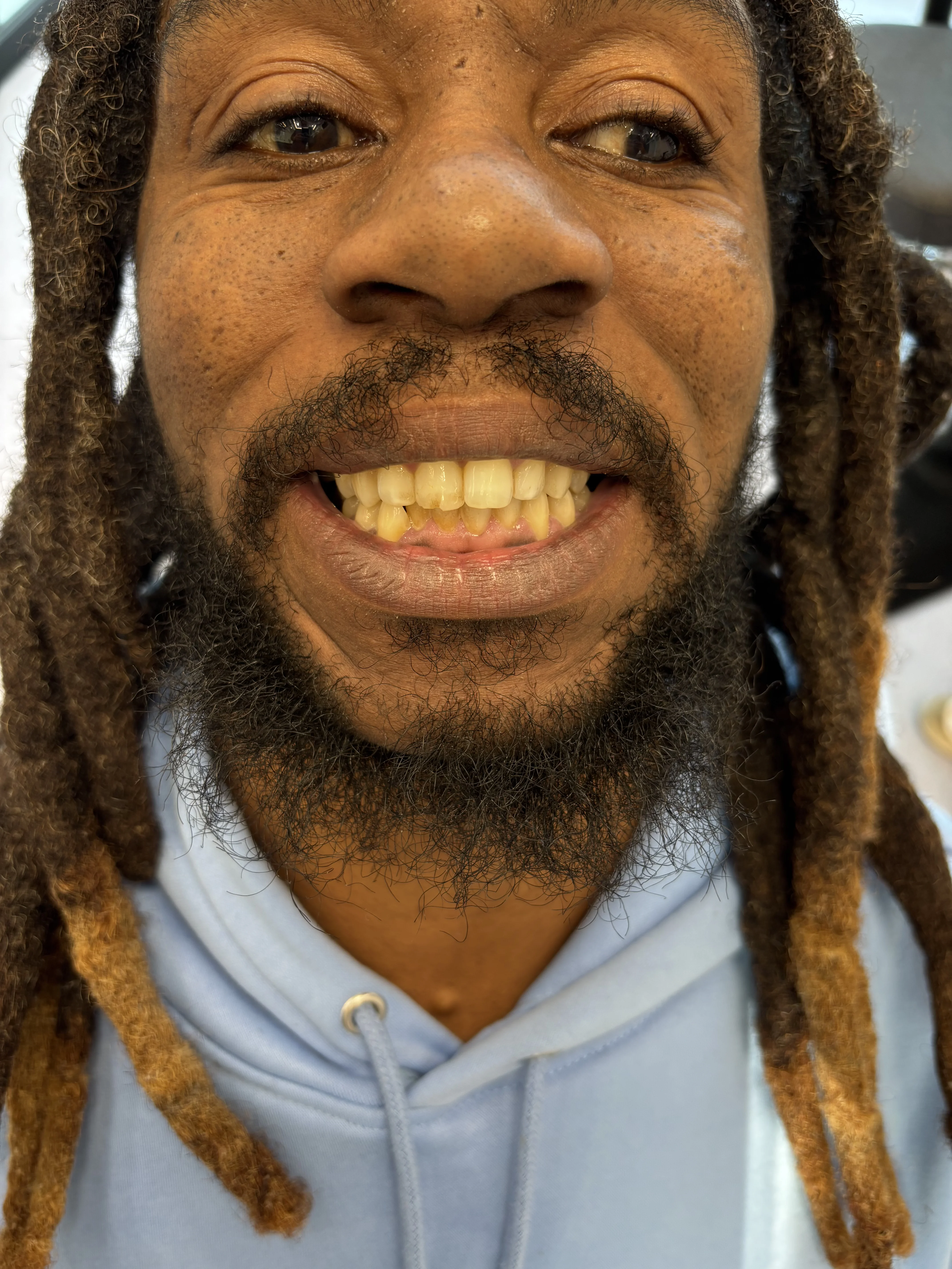 Composite bonding before case 3 — Istanbul