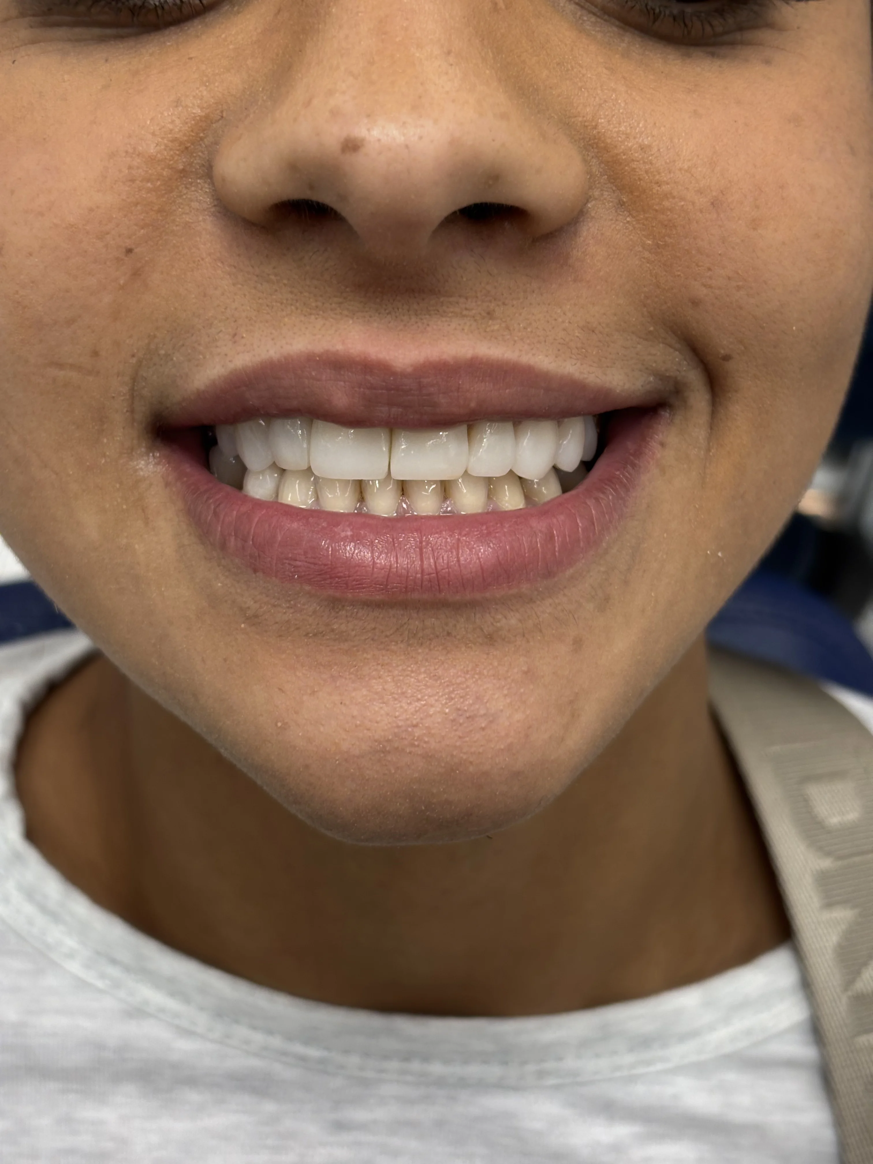 Composite bonding after case 4 — Istanbul NexWell