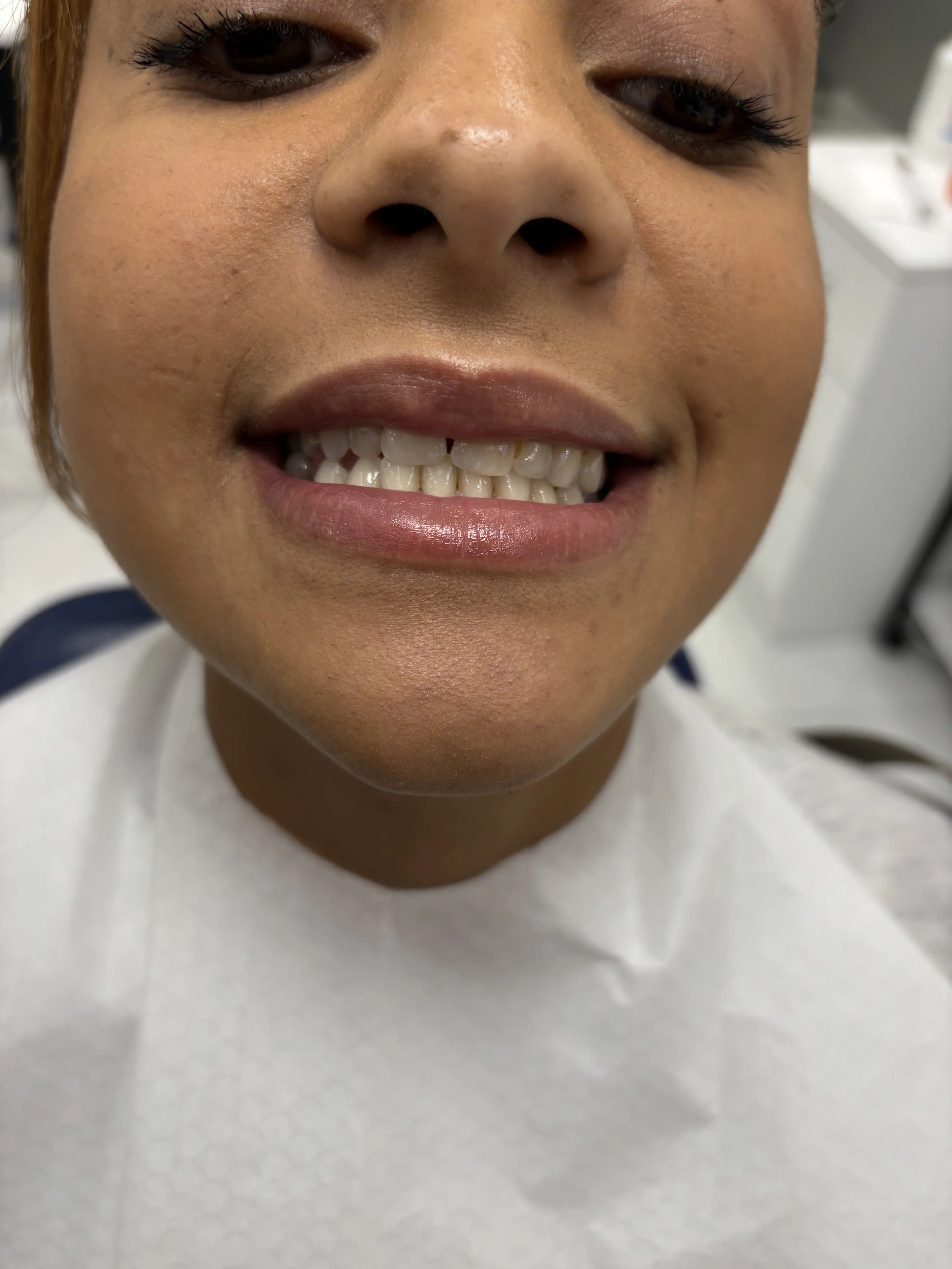 Composite bonding before case 4 — Istanbul