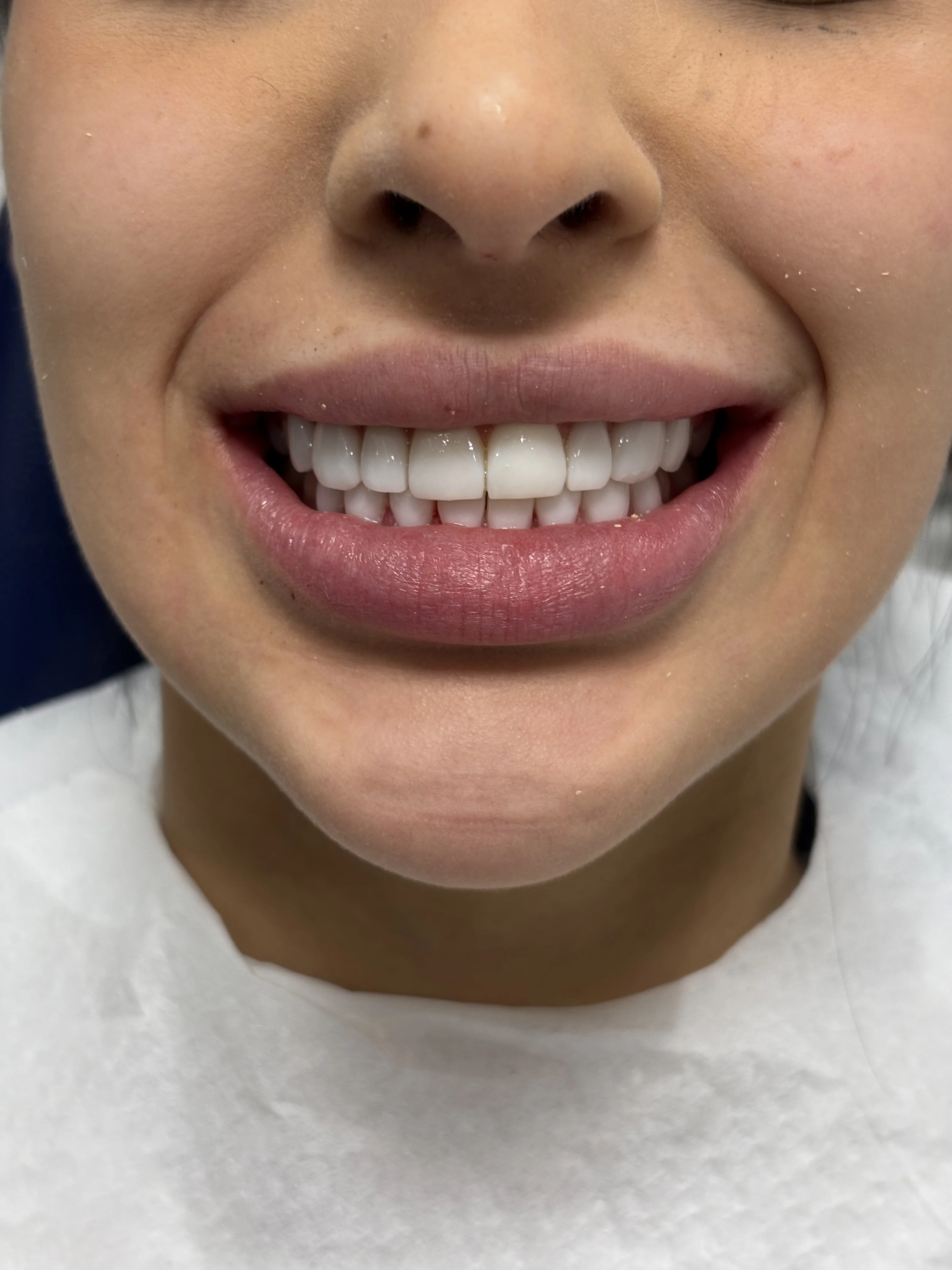 Composite bonding after case 5 — Istanbul NexWell
