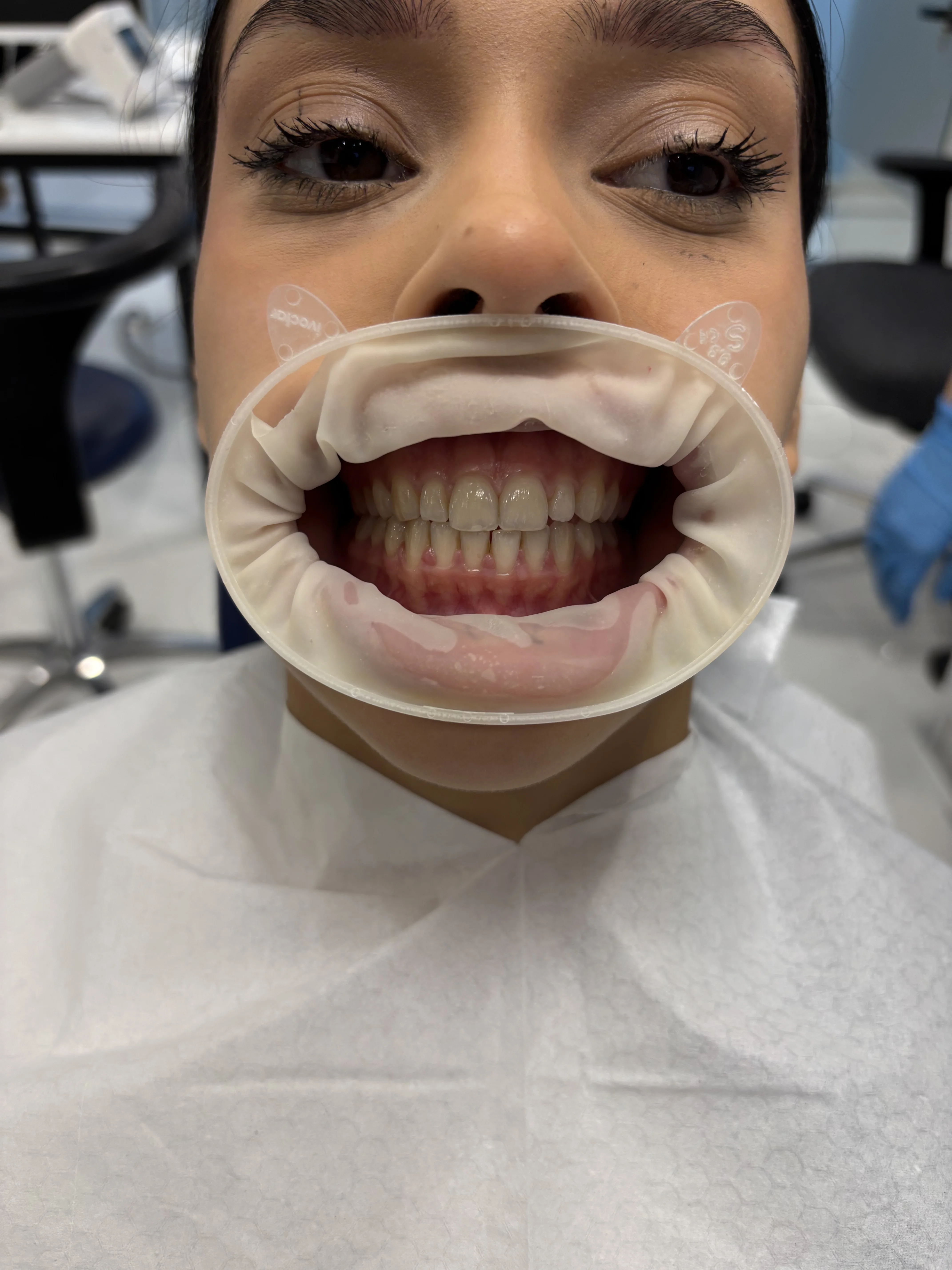 Composite bonding before case 5 — Istanbul