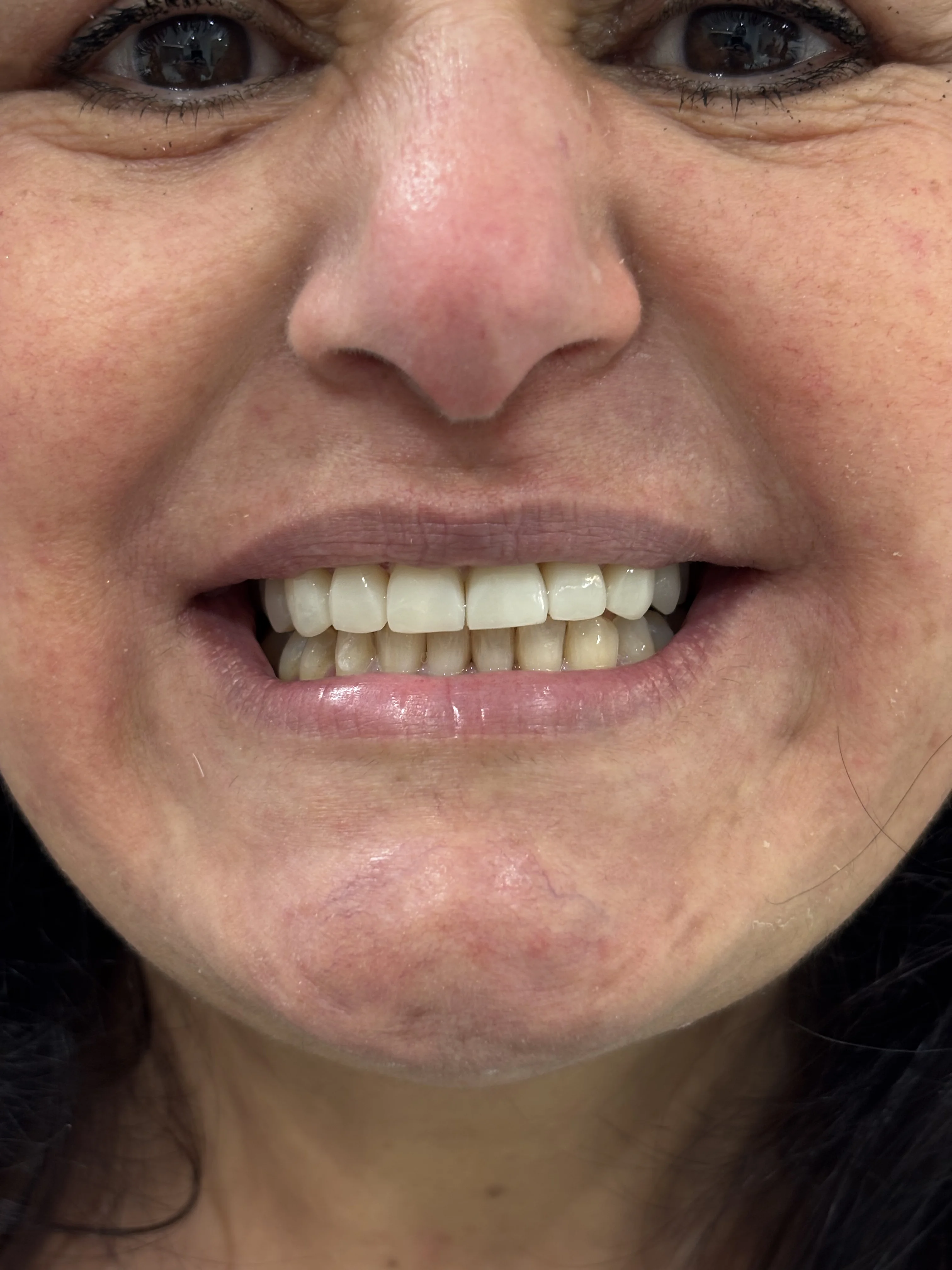 Composite bonding after case 6 — Istanbul NexWell