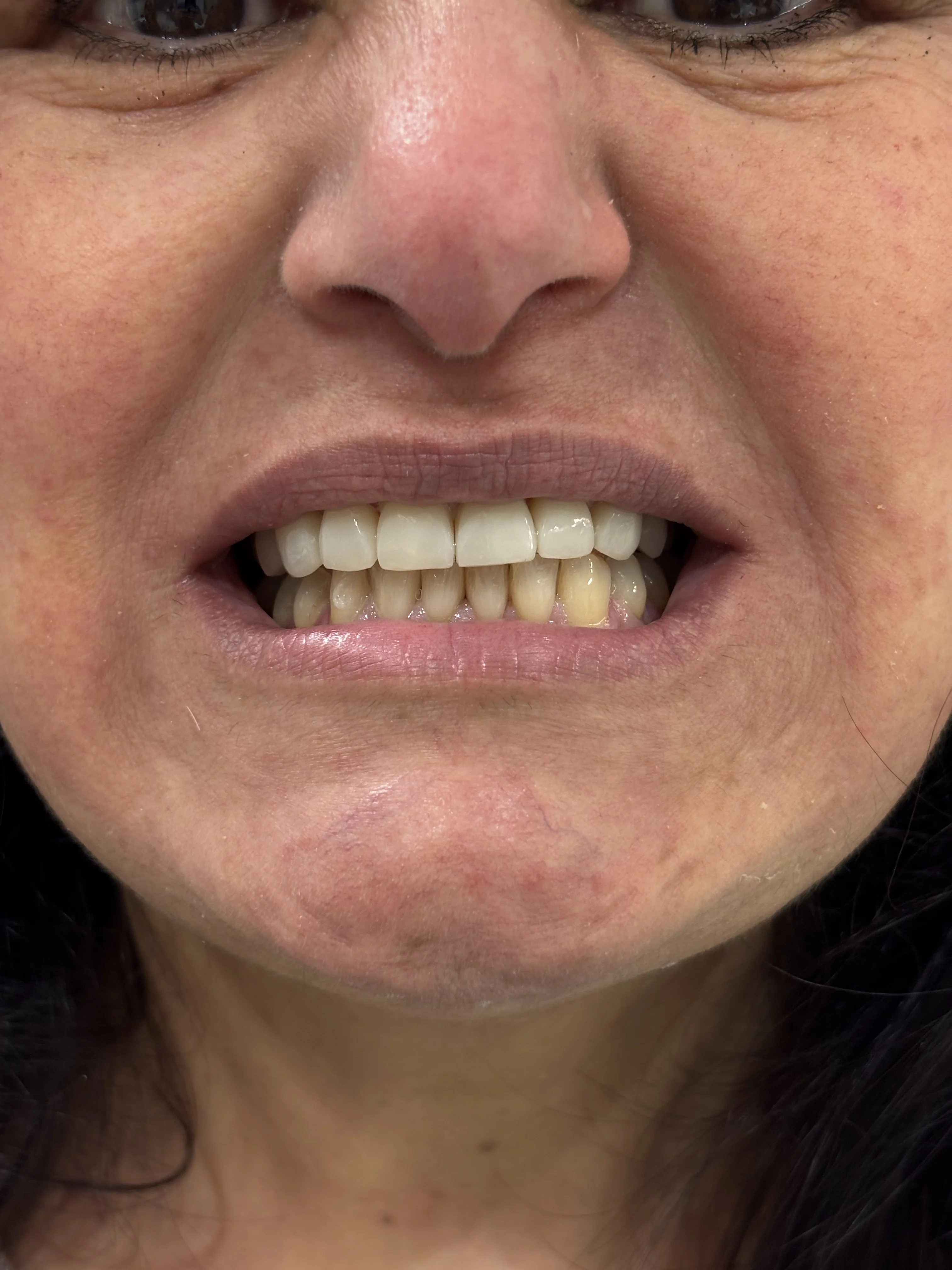 Composite bonding before case 6 — Istanbul