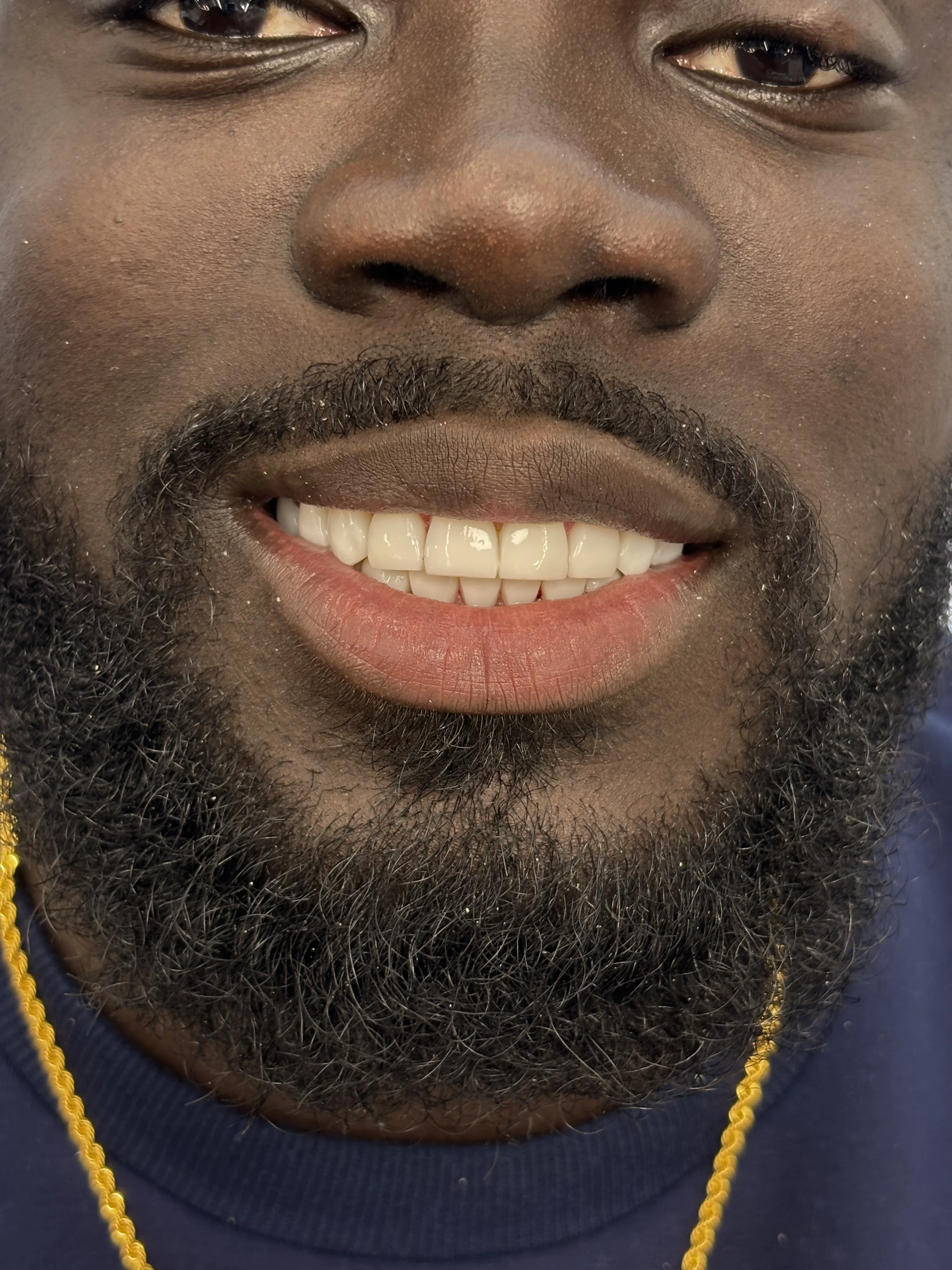 Composite bonding after case 7 — Istanbul NexWell