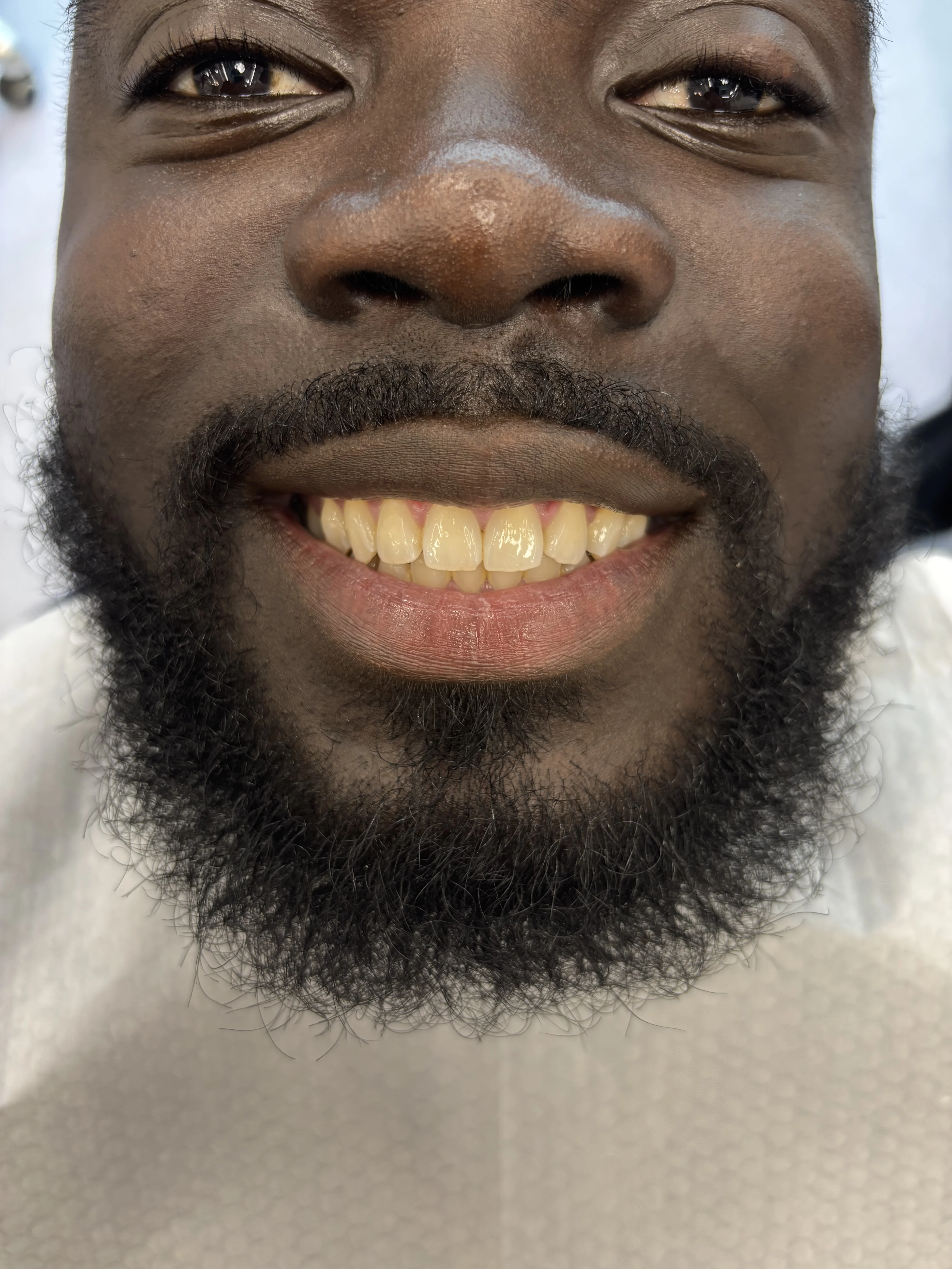 Composite bonding before case 7 — Istanbul