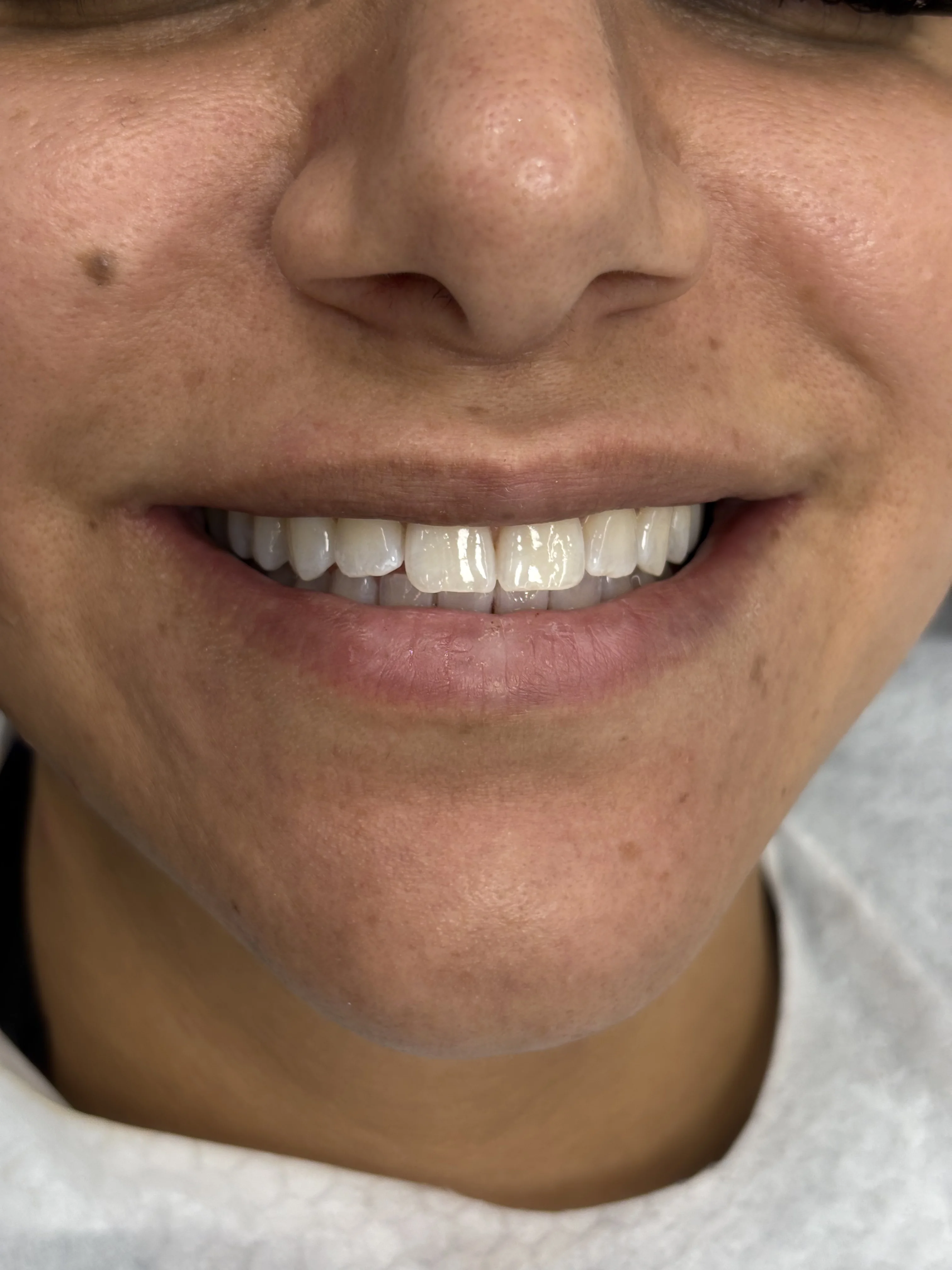 Composite bonding after case 8 — Istanbul NexWell