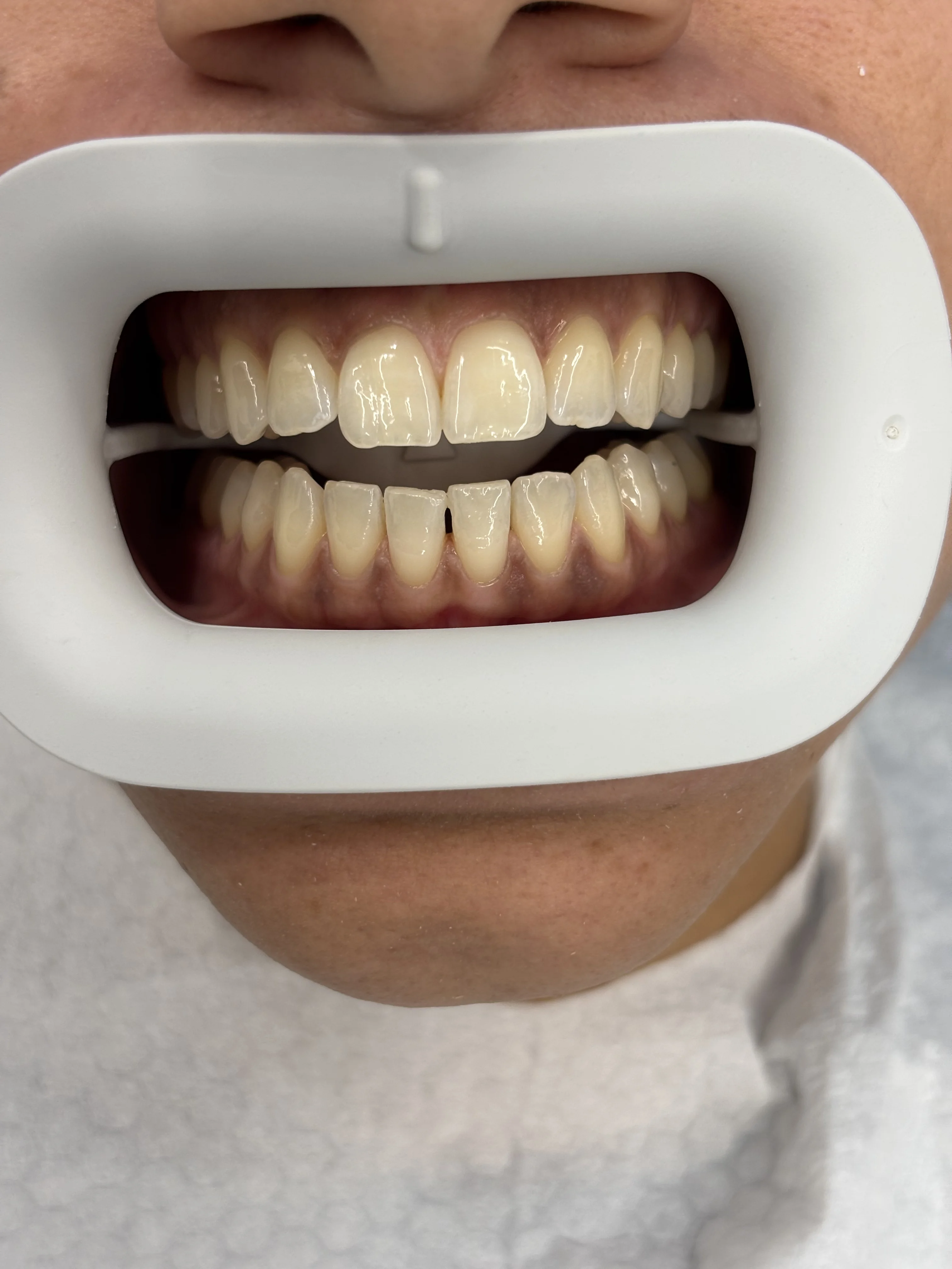 Composite bonding before case 8 — Istanbul