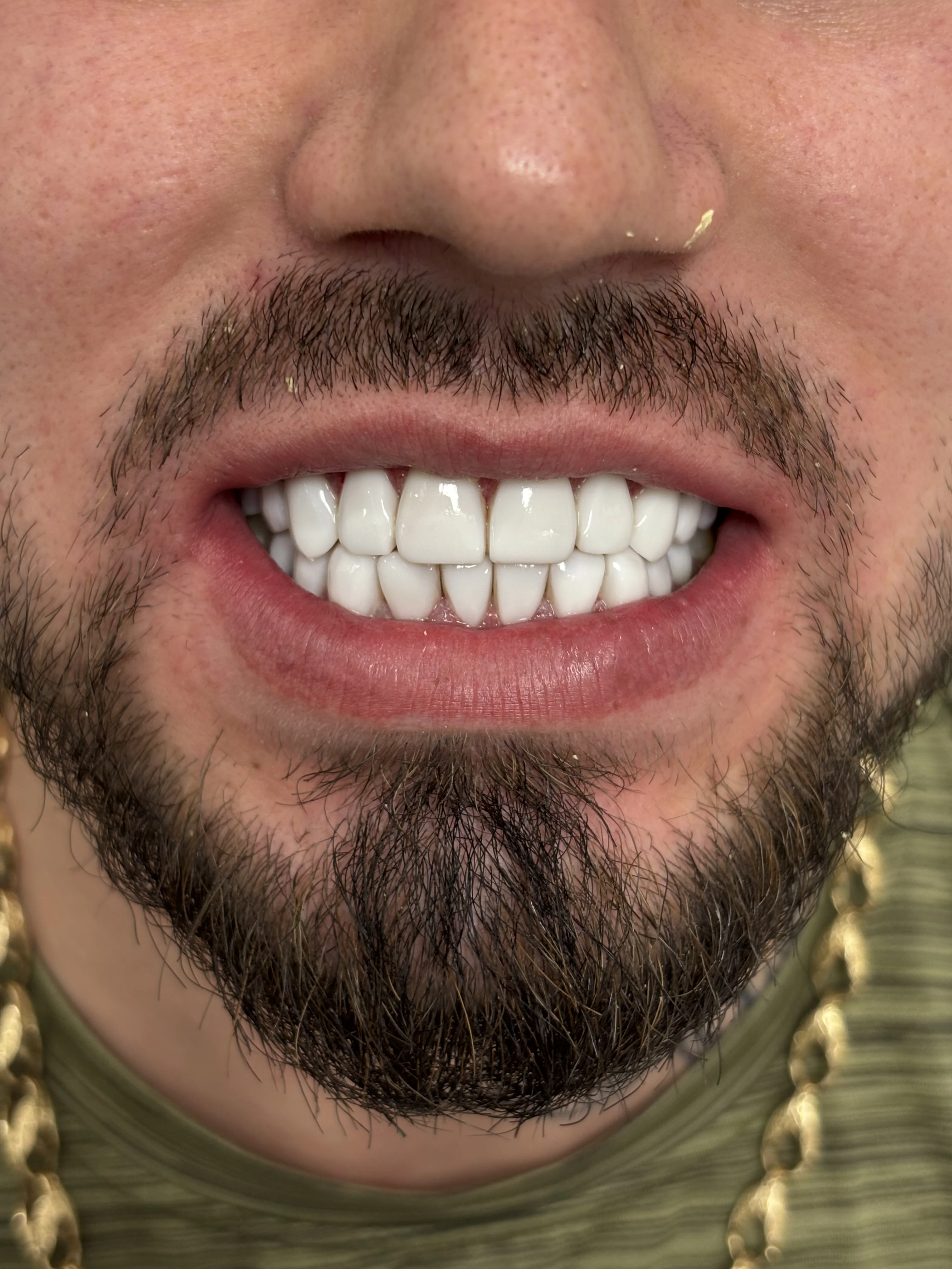 Composite bonding after case 9 — Istanbul NexWell