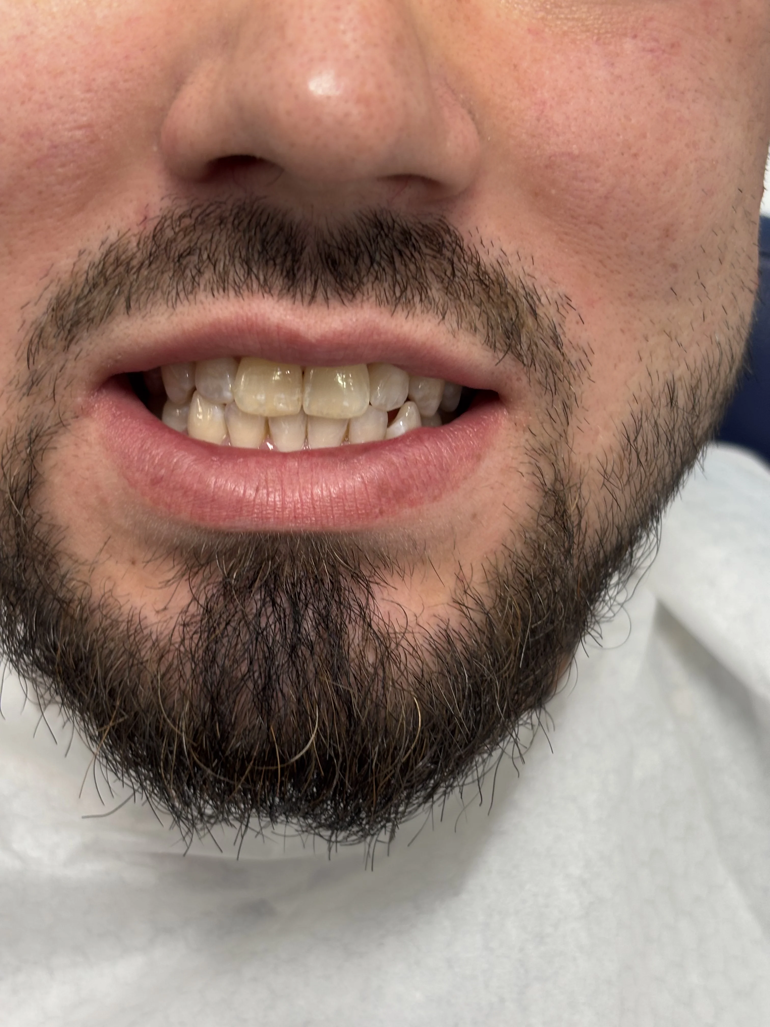 Composite bonding before case 9 — Istanbul