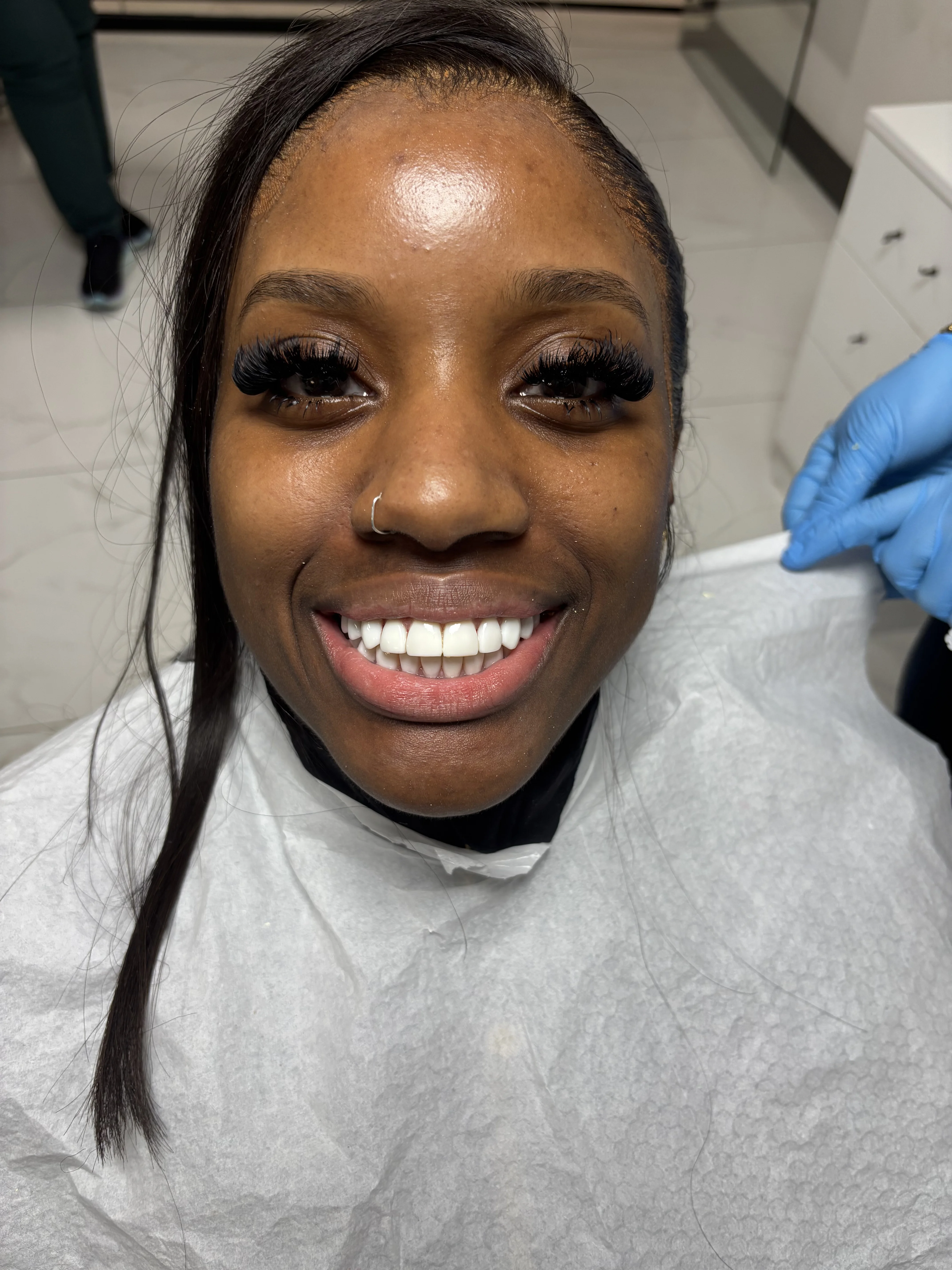 Composite bonding after case 10 — Istanbul NexWell