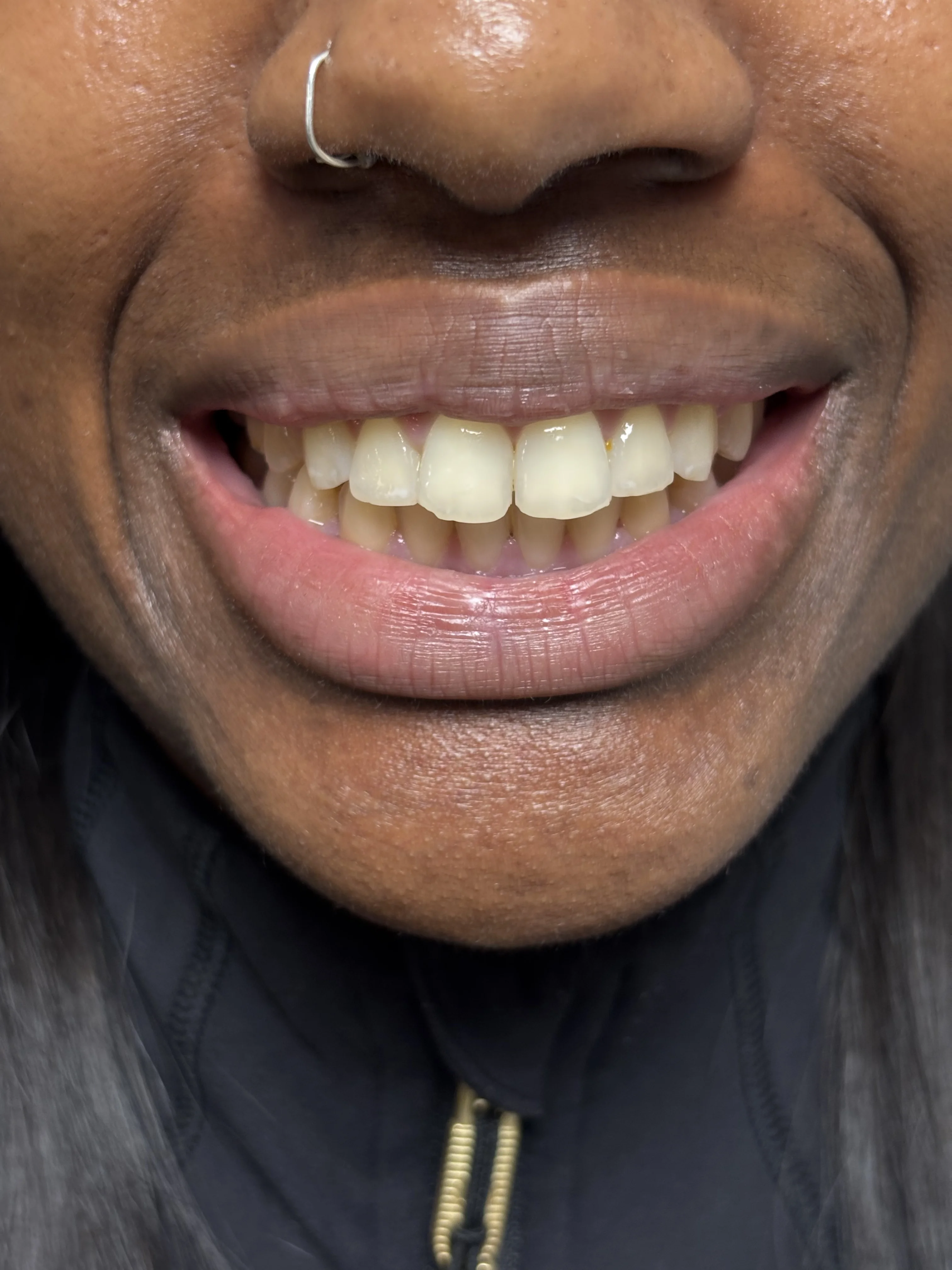 Composite bonding before case 10 — Istanbul