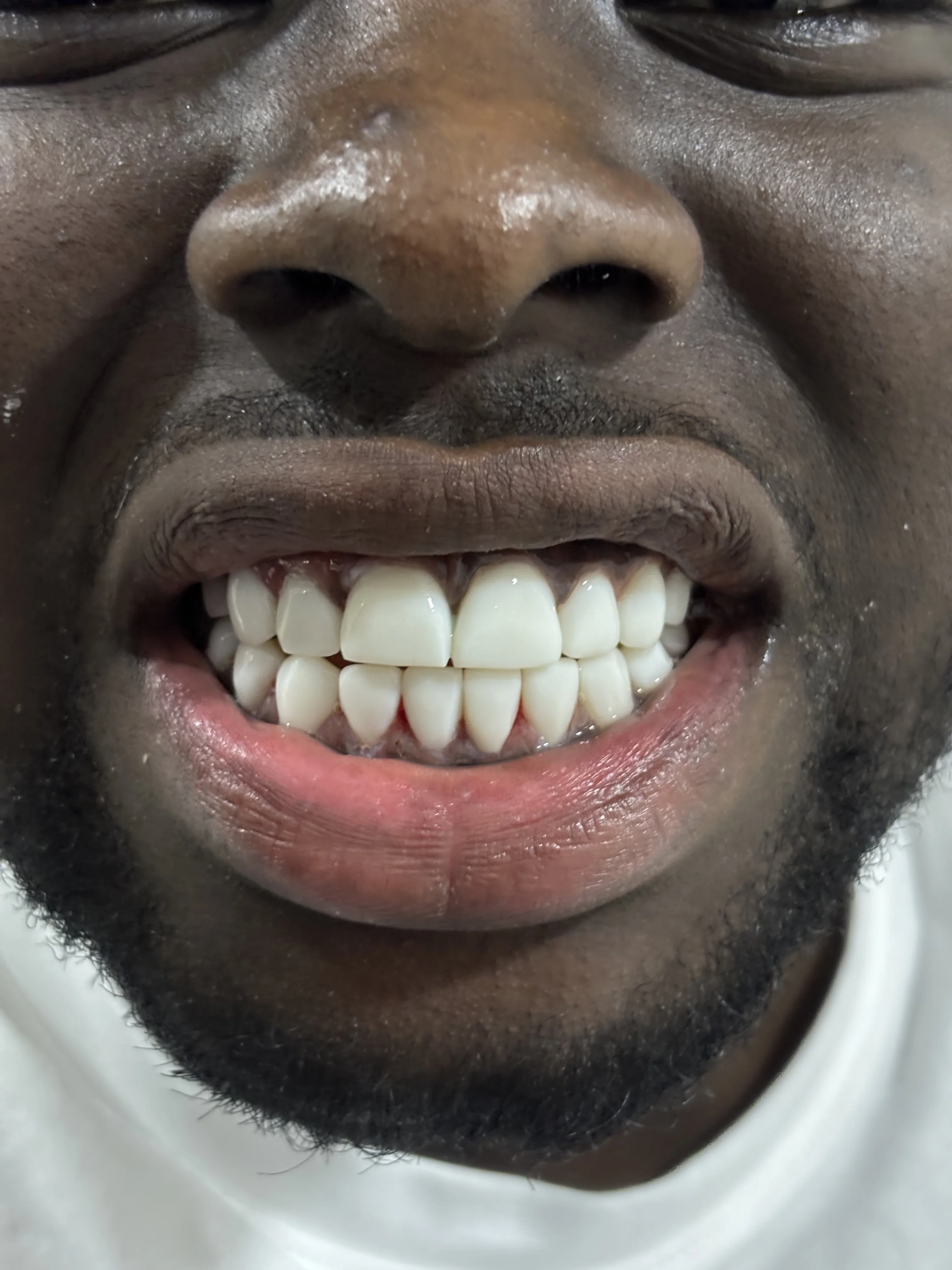 Composite bonding after case 11 — Istanbul NexWell