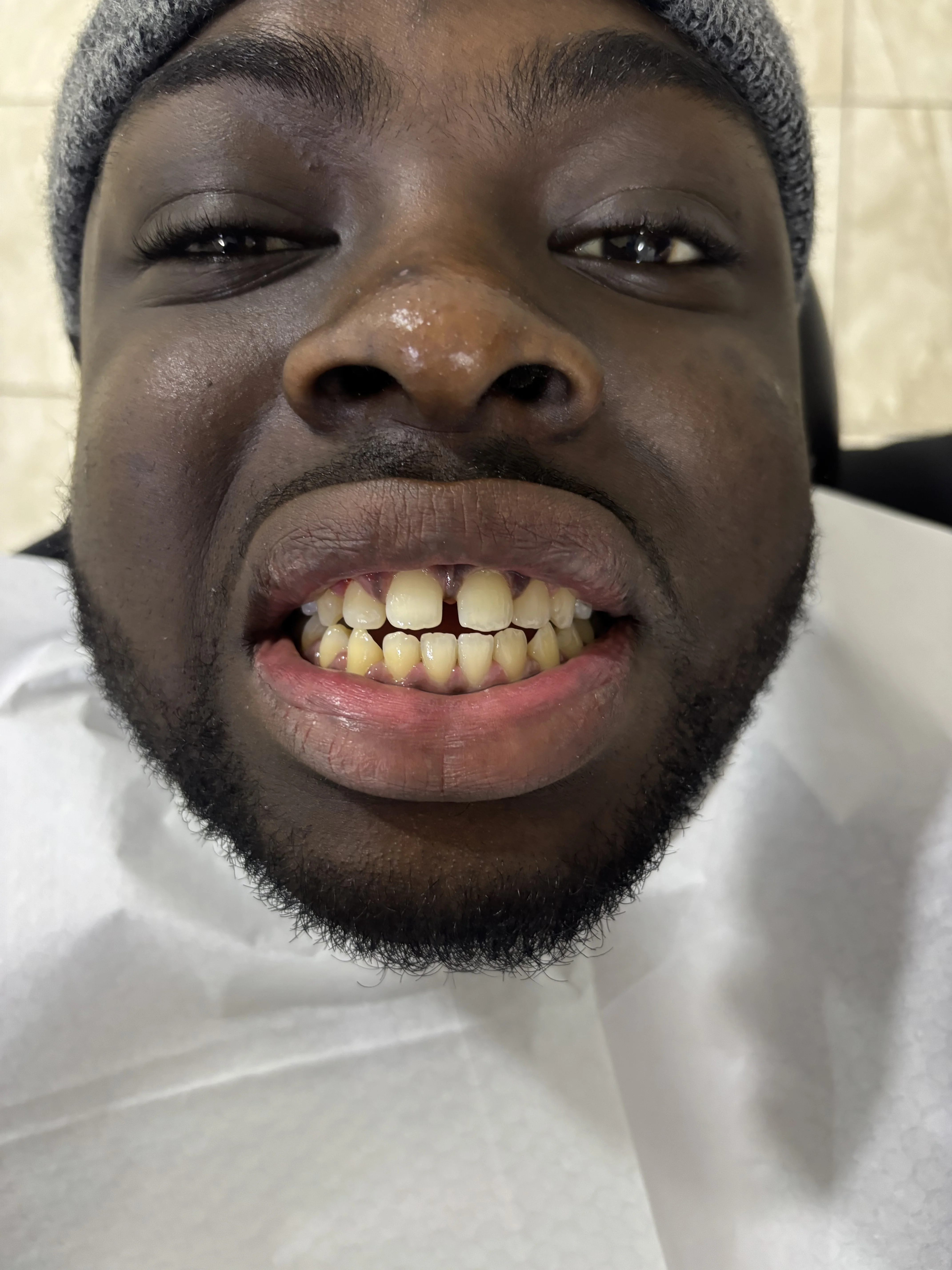 Composite bonding before case 11 — Istanbul