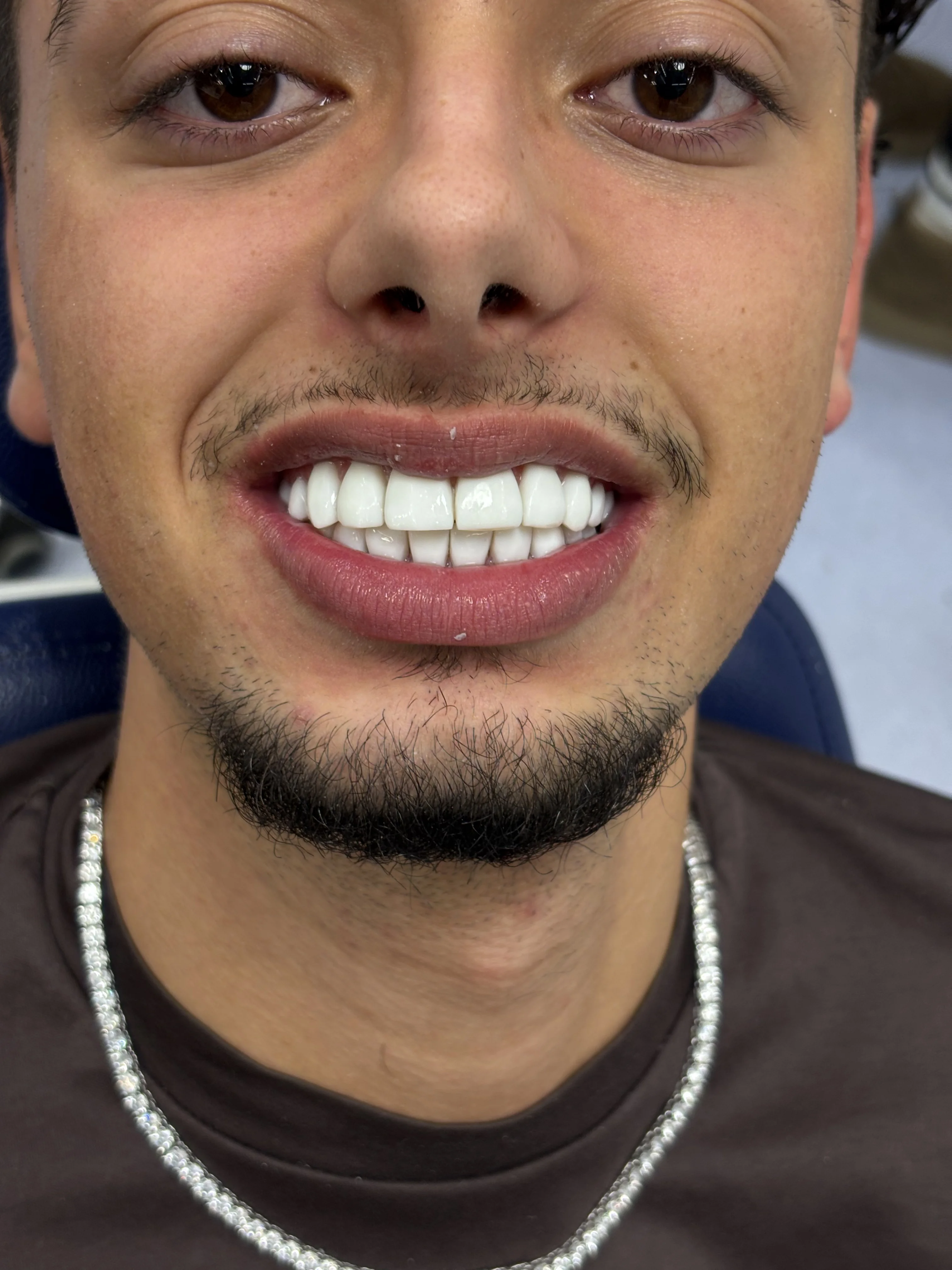 Composite bonding after case 12 — Istanbul NexWell