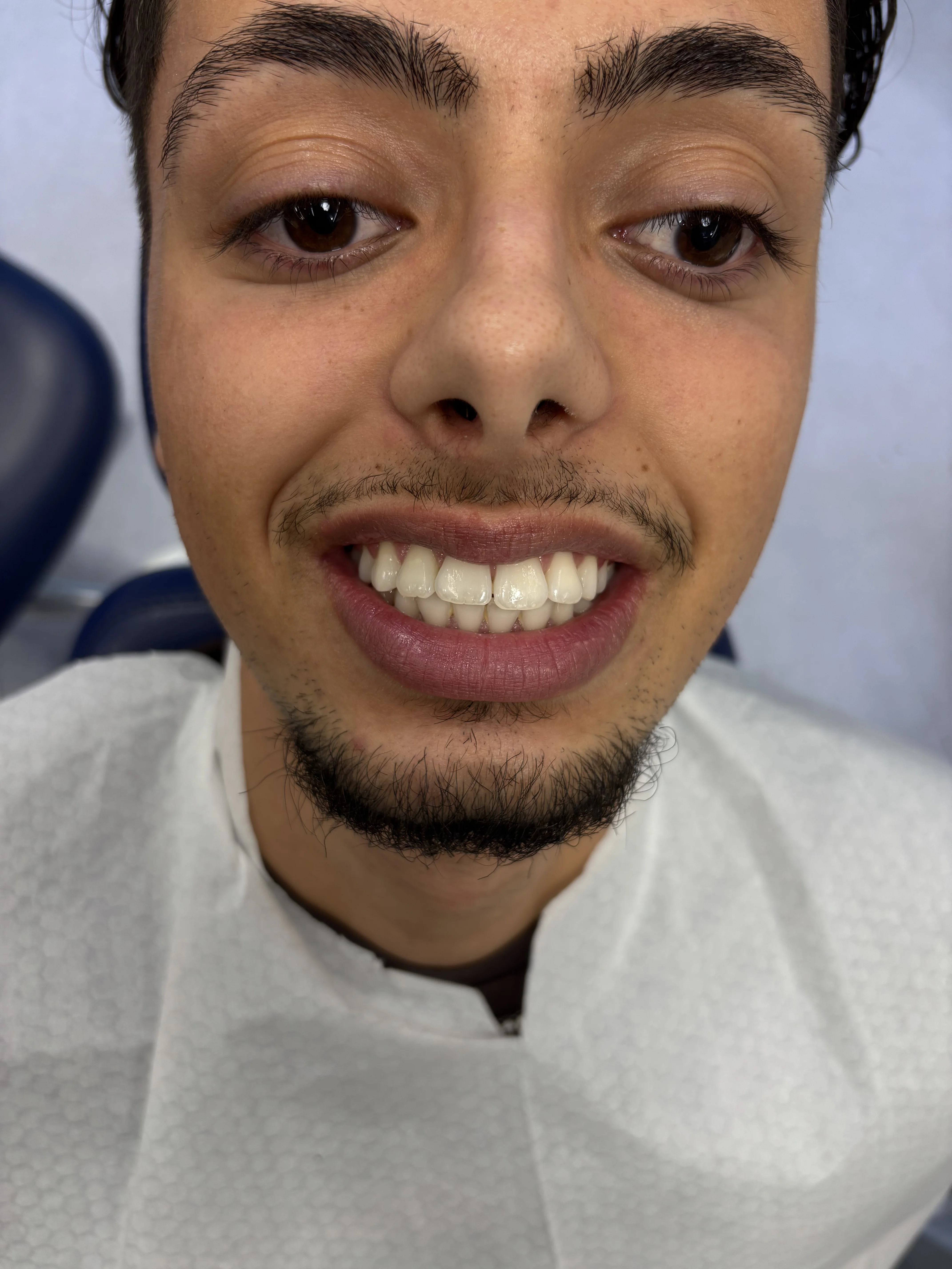 Composite bonding before case 12 — Istanbul
