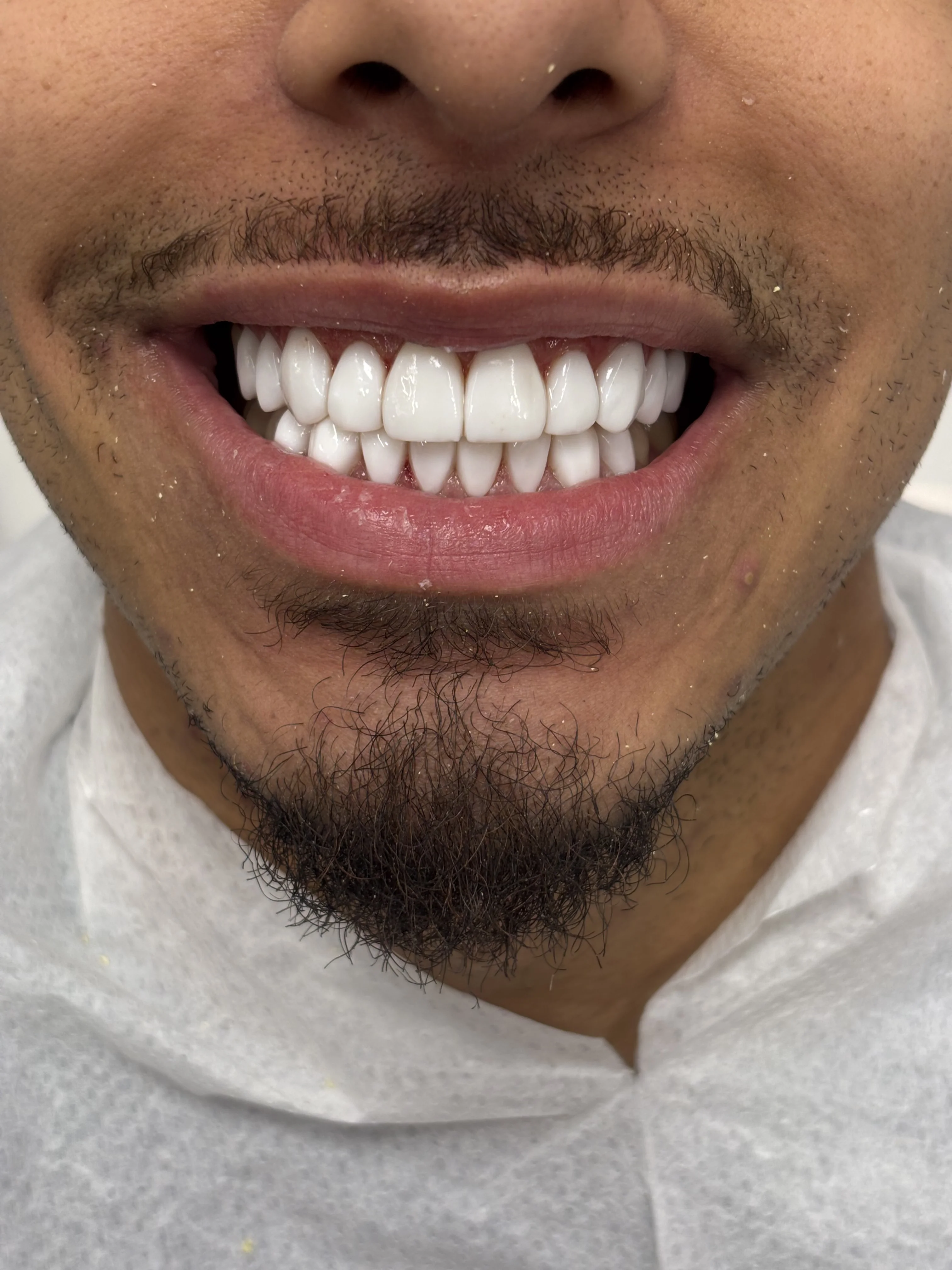 Composite bonding after case 13 — Istanbul NexWell