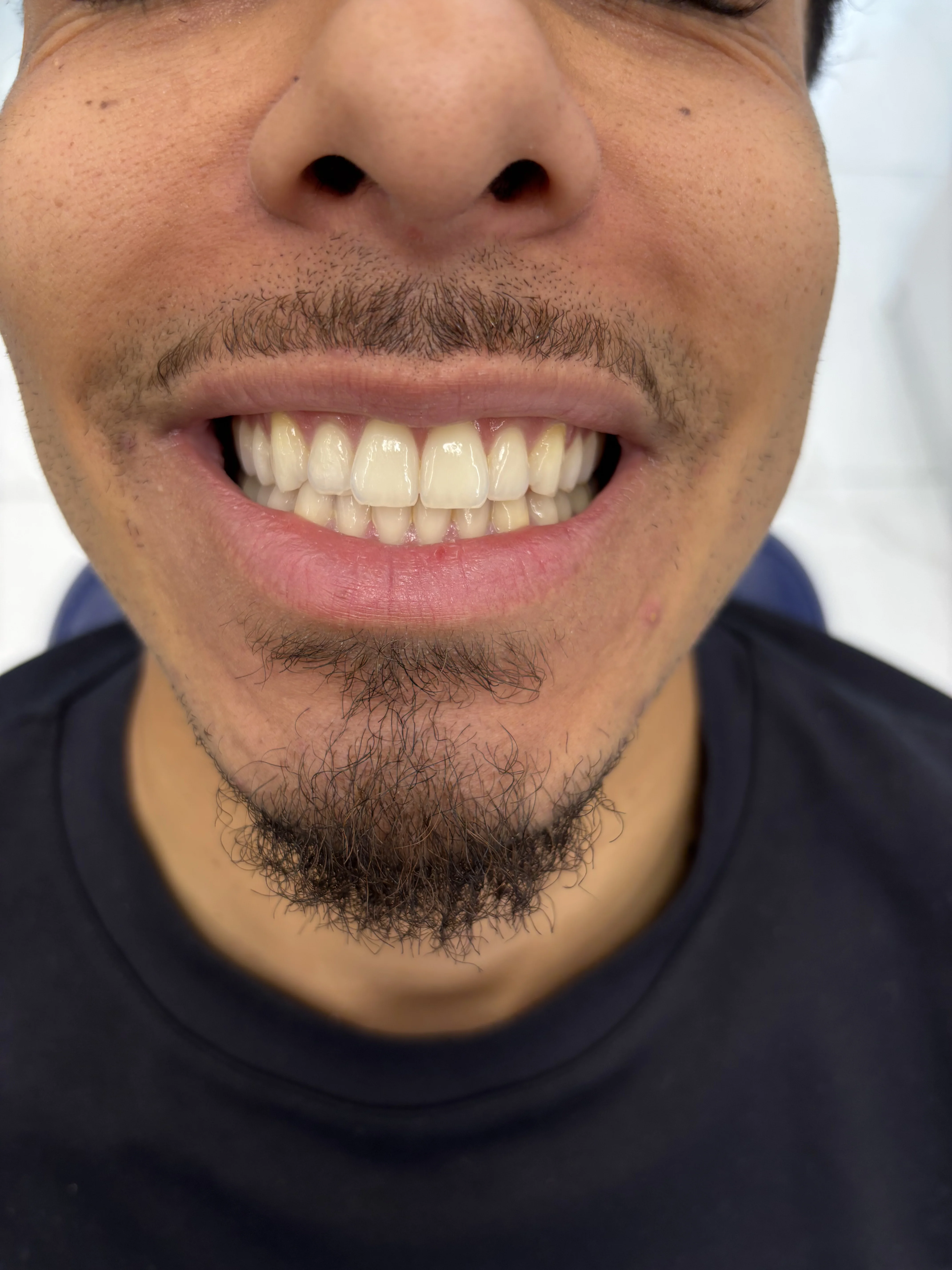Composite bonding before case 13 — Istanbul