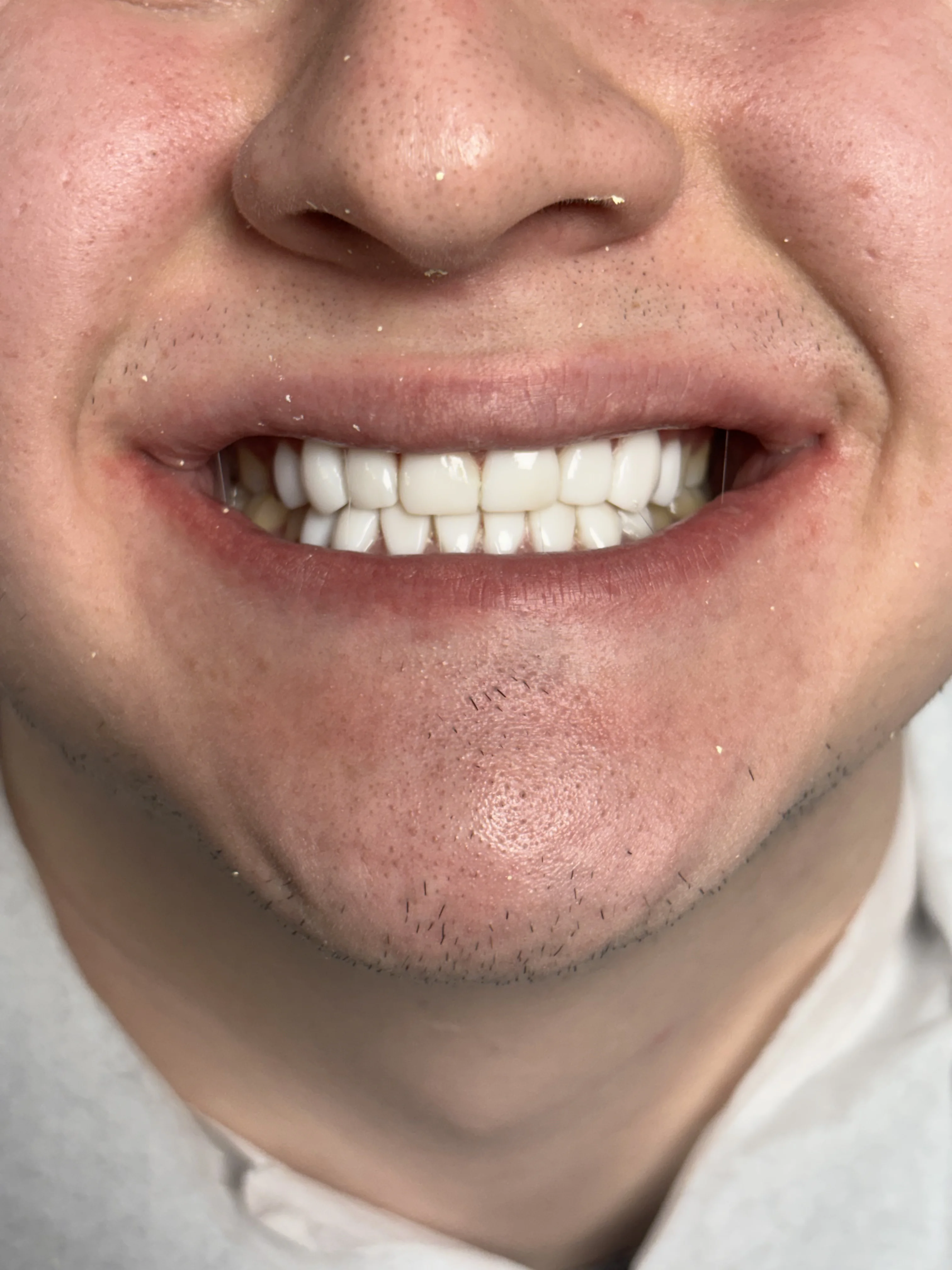 Composite bonding after case 14 — Istanbul NexWell