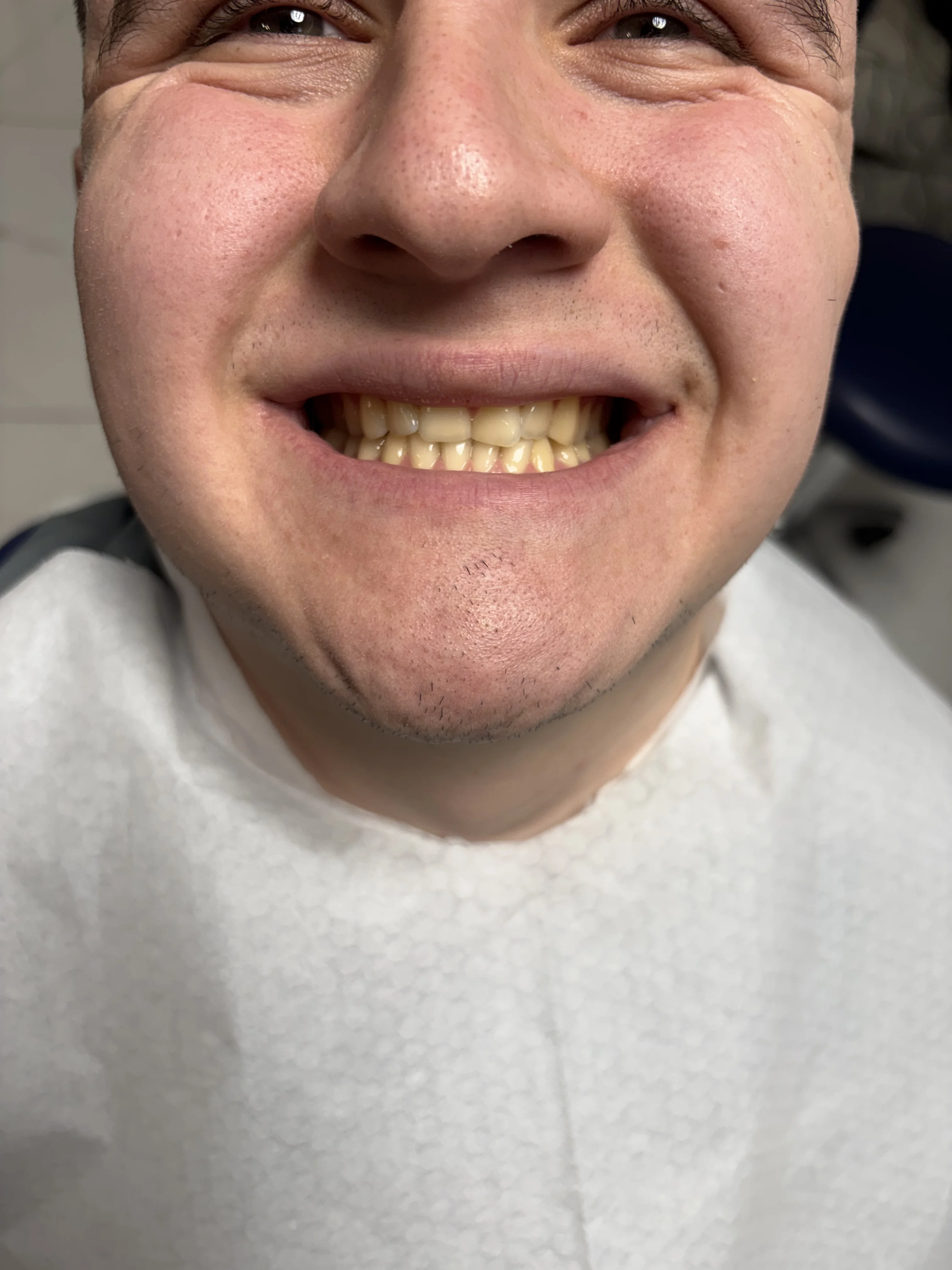 Composite bonding before case 14 — Istanbul